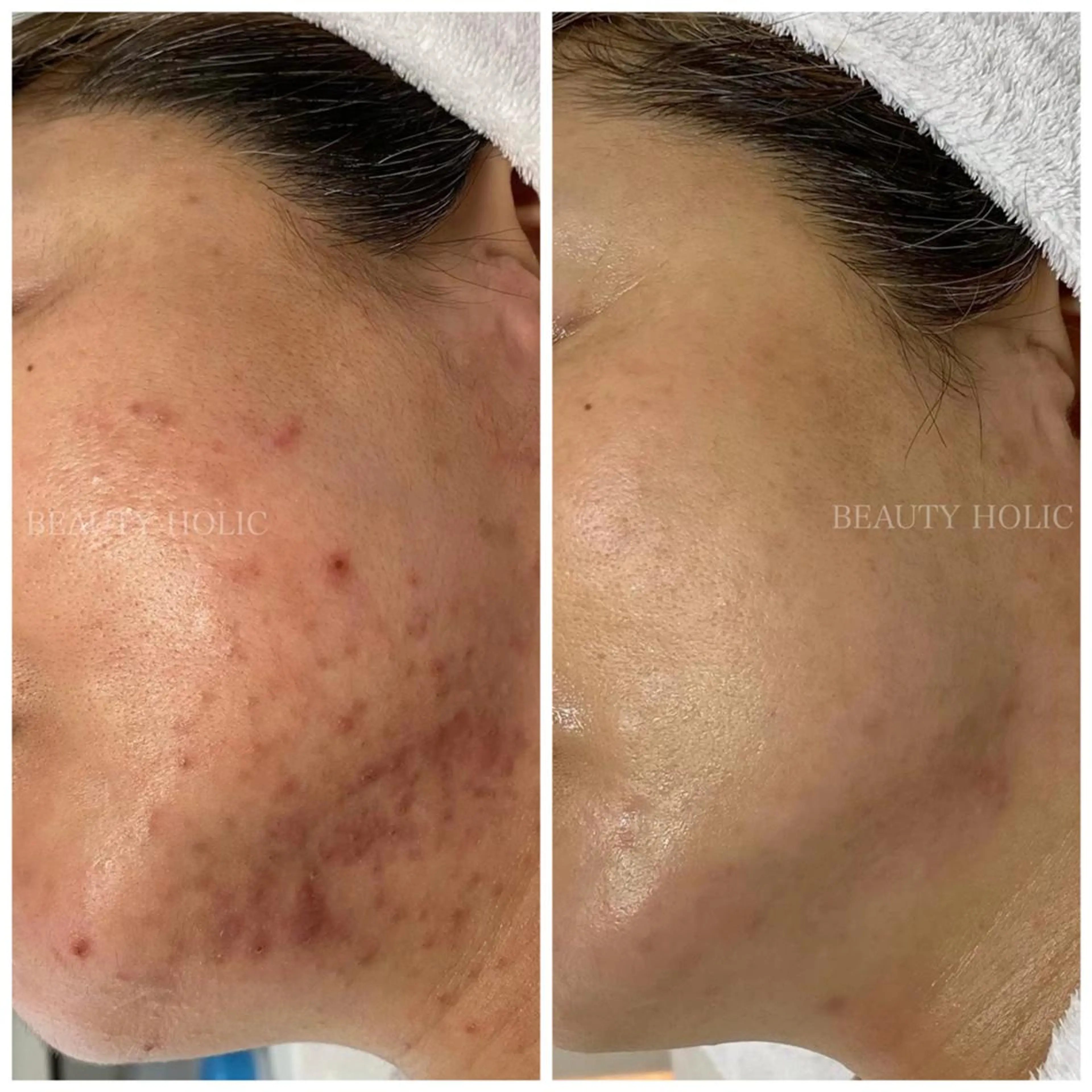 ニキビ悩みにもオススメ💡韓国式ショートカットピーリング✨※剥離なしの写真