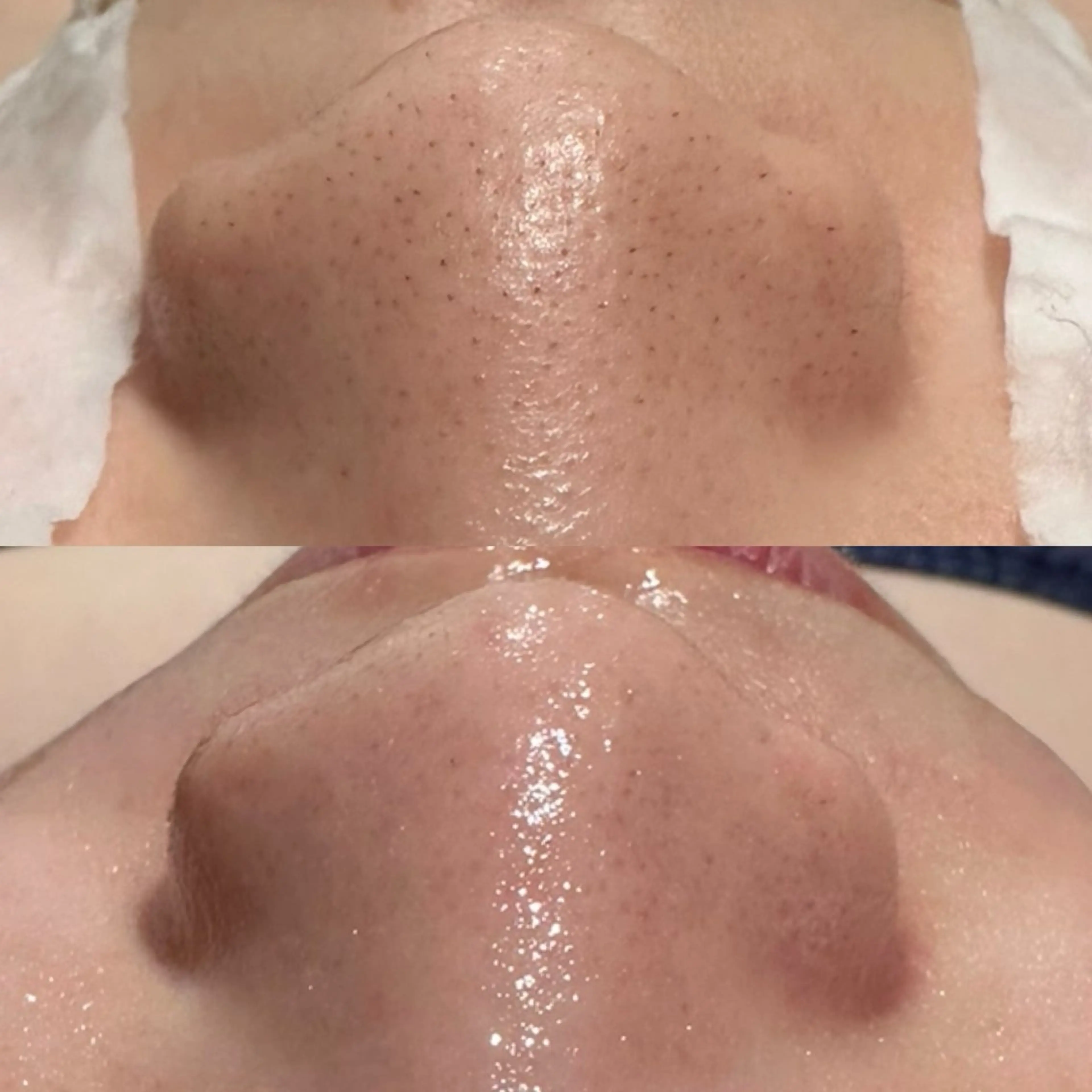 👶🏻ハイドロ+小顔コース👶🏻毛穴ツルツル、黒ずみ除去、スッキリ小顔引き締め✨の写真