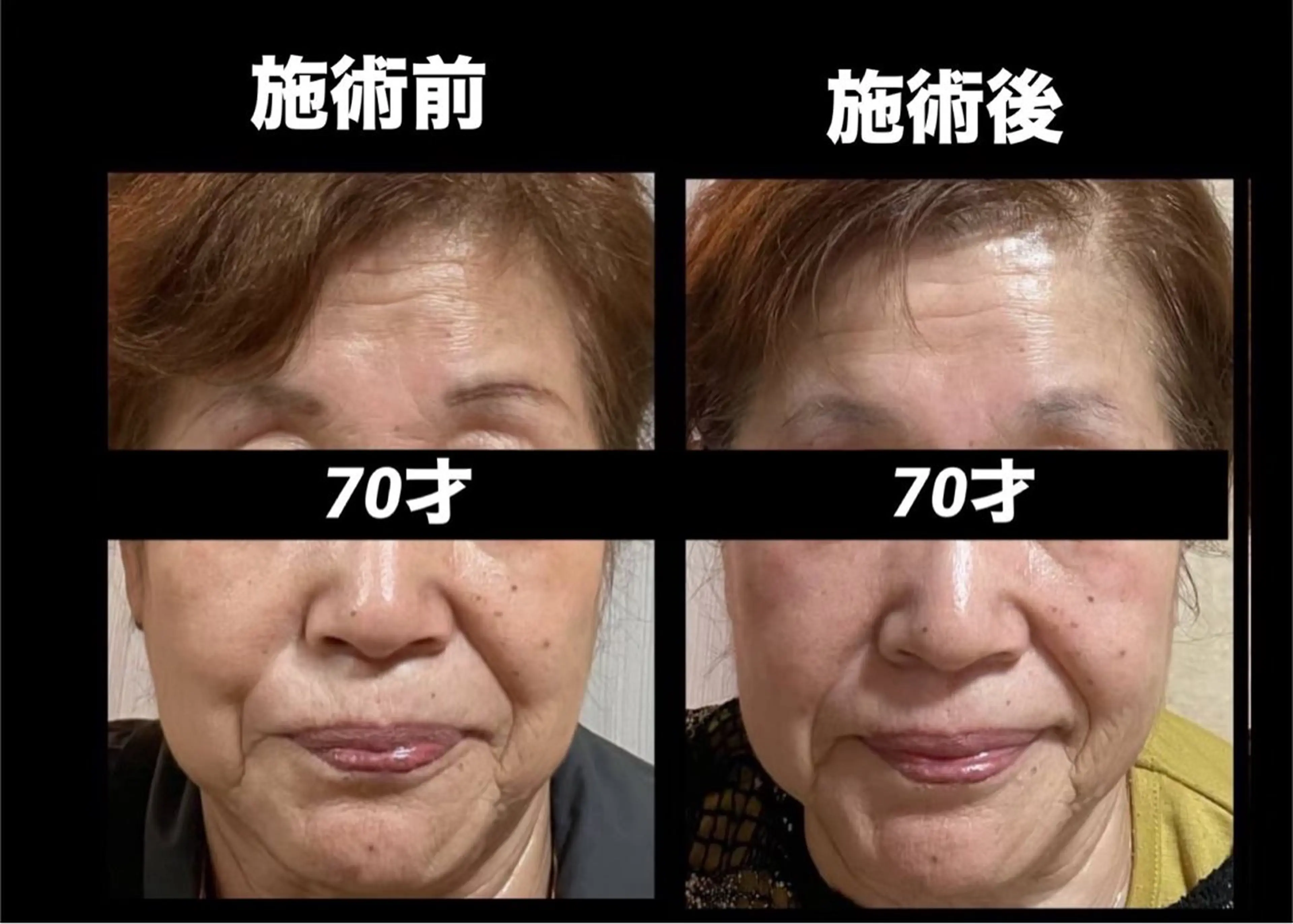 🌷オールハンドエステ(フェイシャル➕デコルテ➕ヘッド)60分の写真