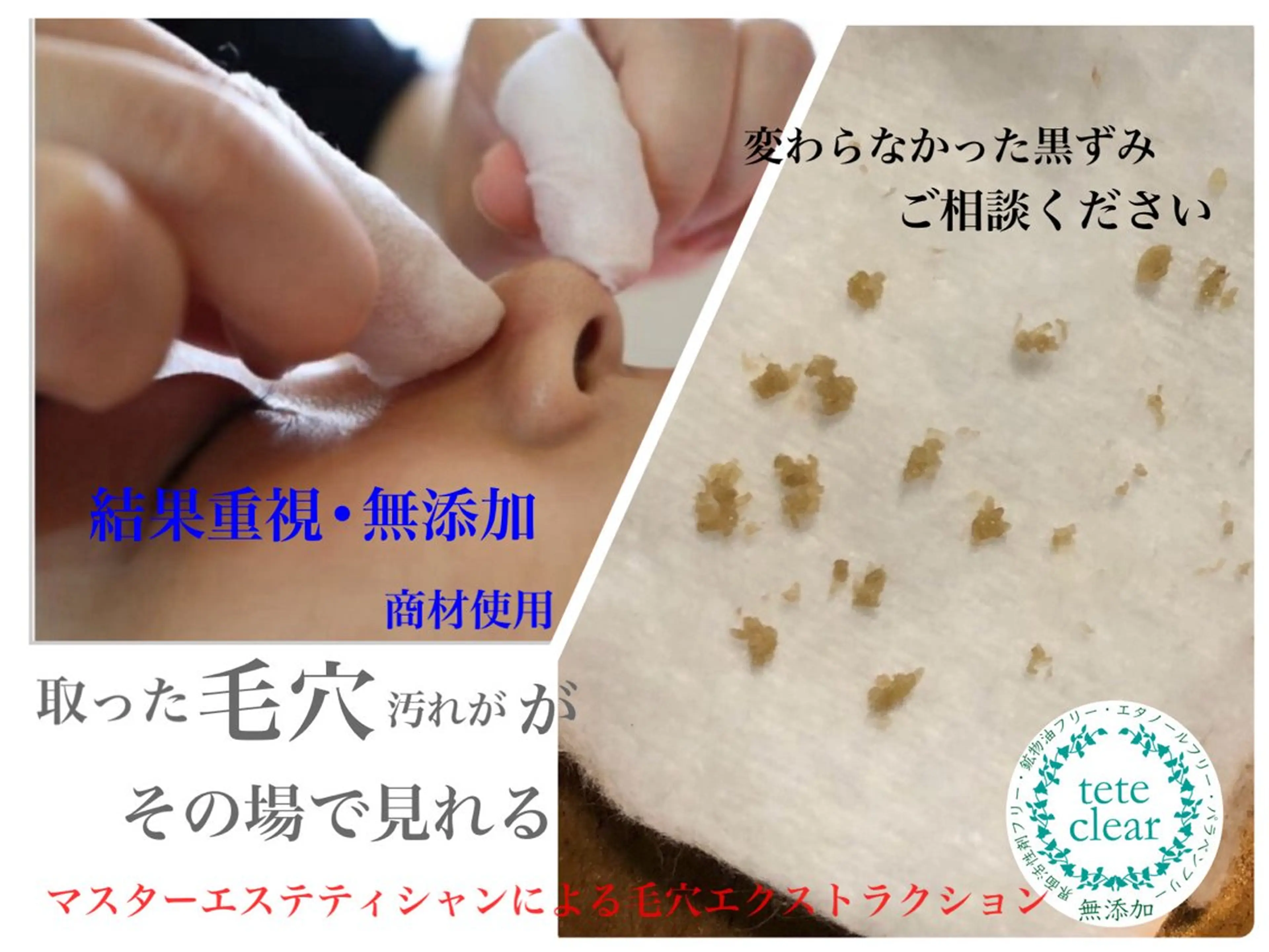 【いちご鼻、毛穴つまりが気になる方】毛穴エクストラクション＋角質ケアの写真