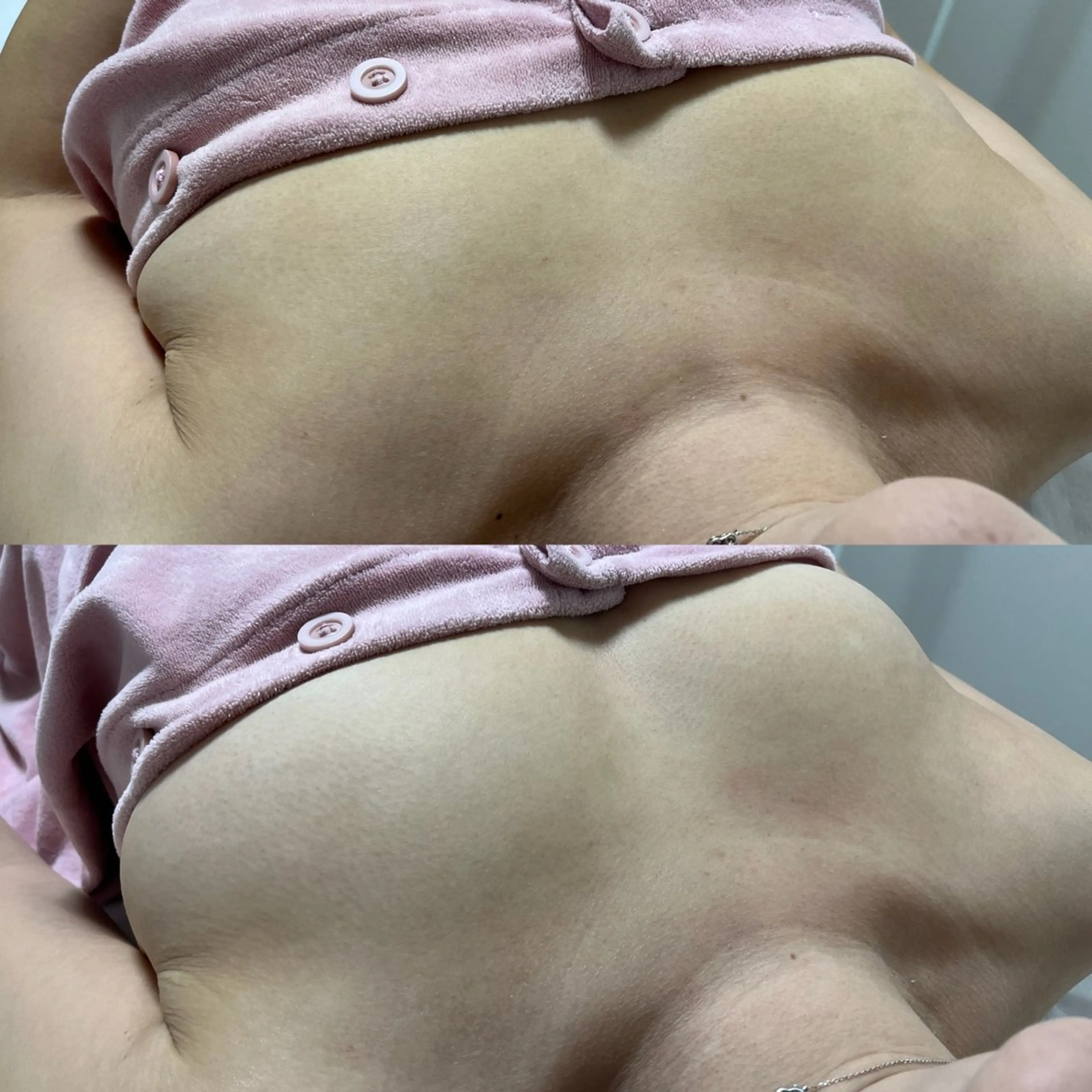 BBL バストアップケアの写真