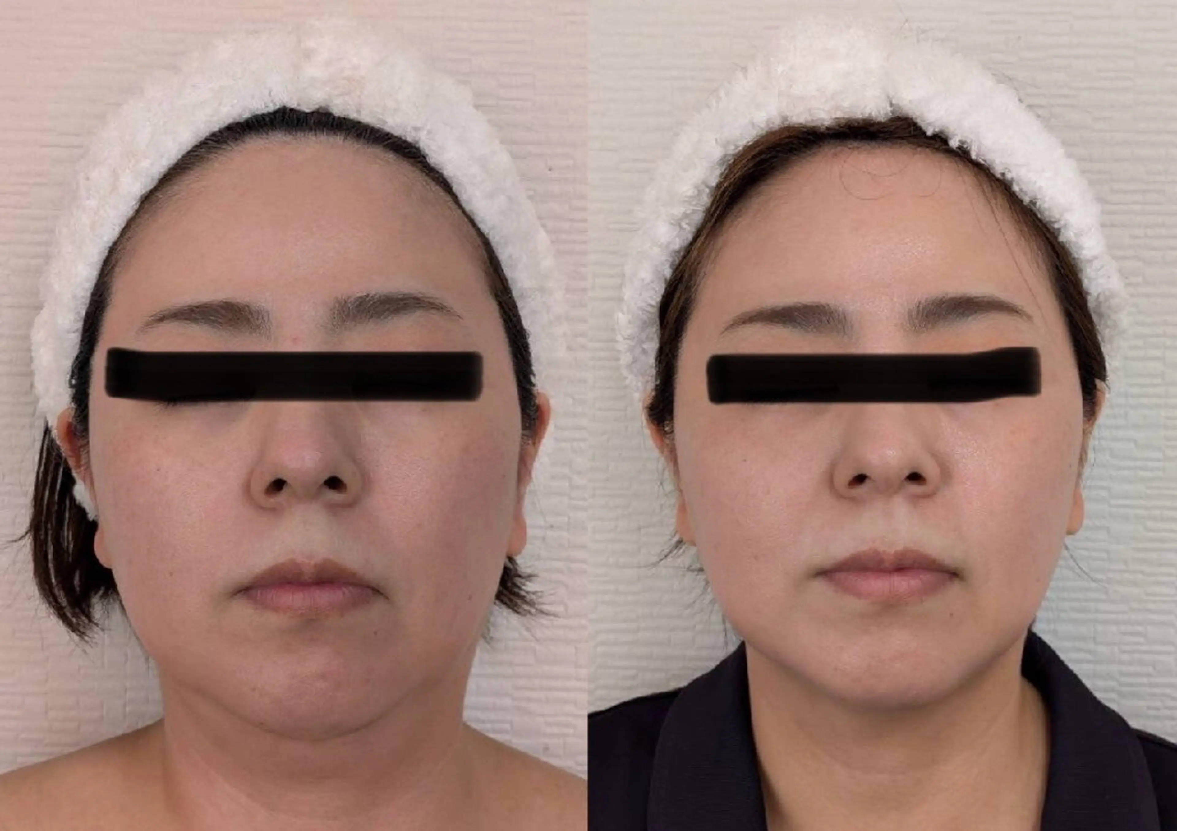 エステ レチノール/ニキビ/ 毛穴ケア　浅川のエステ・リラクイメージ