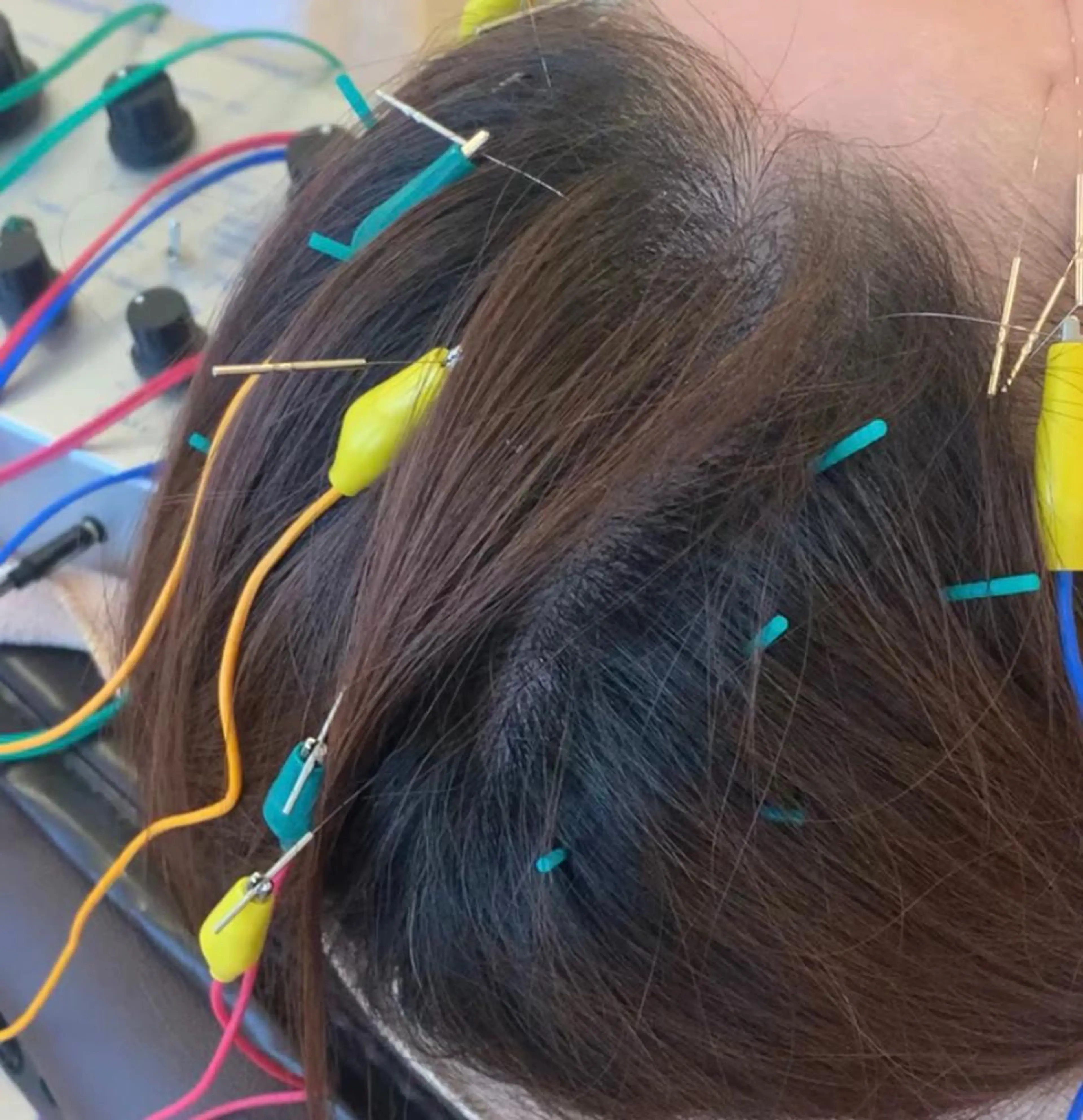 新宿hari-me所属・美容鍼hari-me 新宿のエステ・リラクイメージ