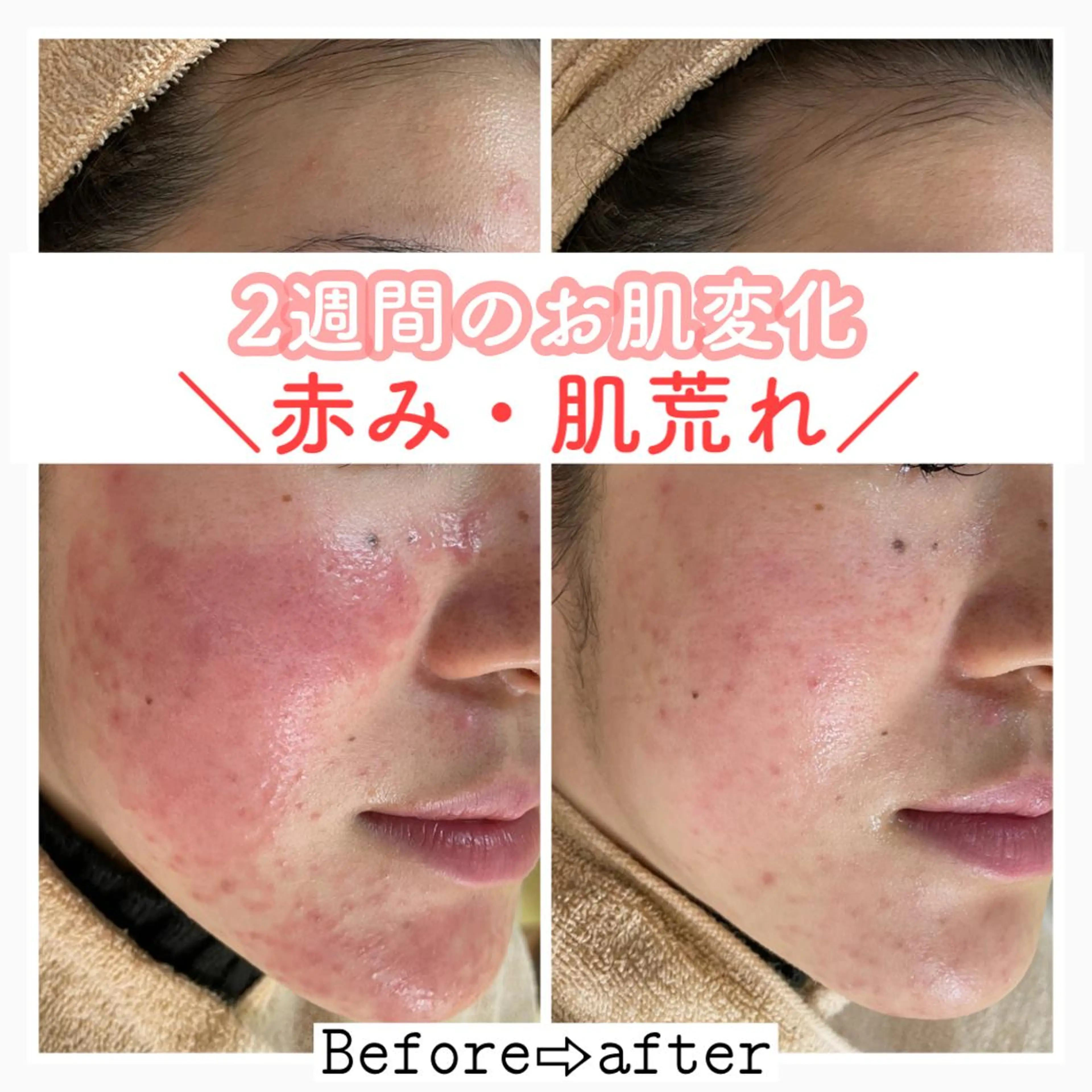 ショート カラー パーマ ヘアアレンジ メンズ キッズ ネイル マツエク・マツパ エステ ニキビ&跡改善サロン オーナー光木のエステ・リラクイメージ