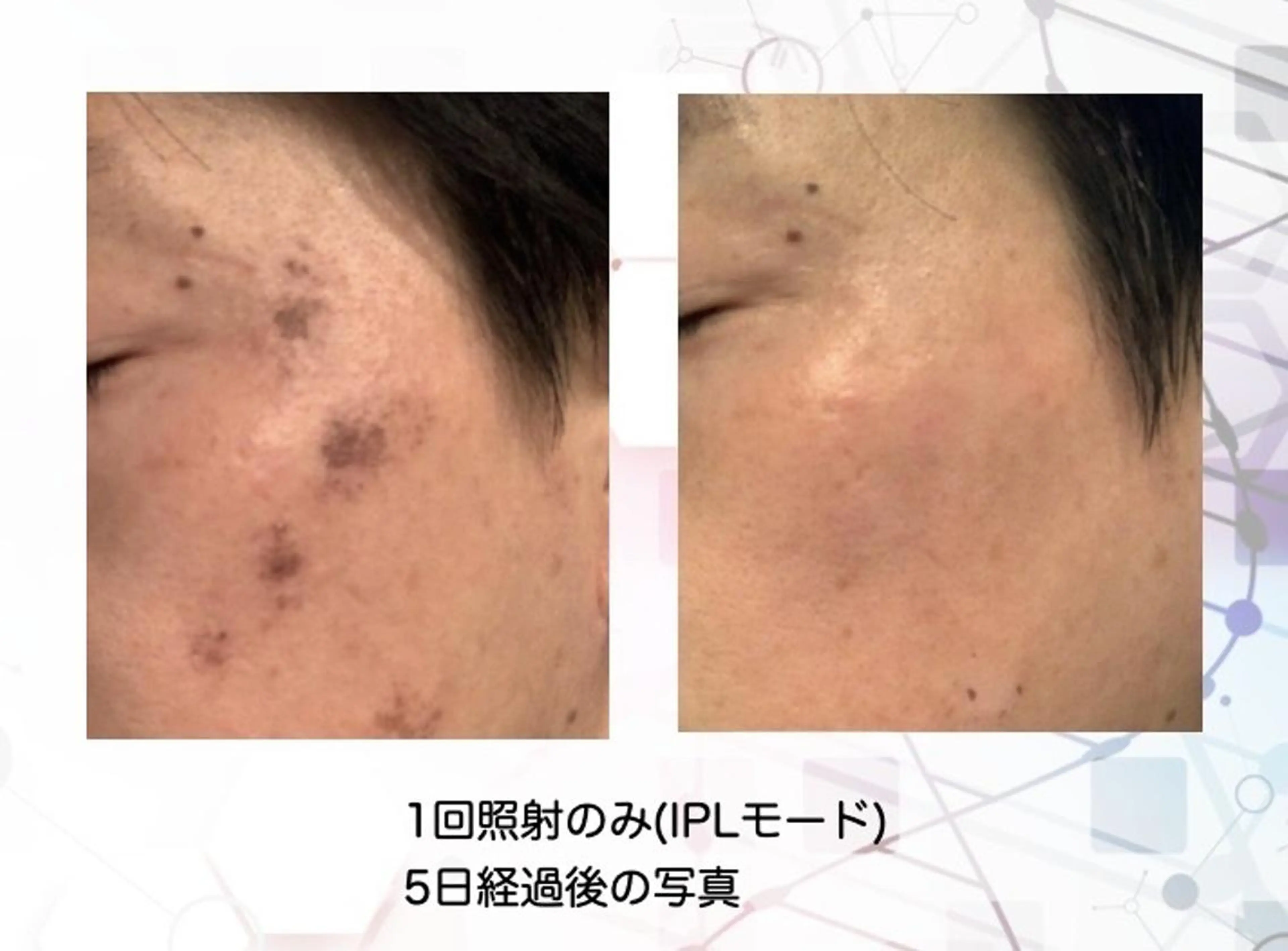 Felice🌸脱毛 ・光フェイシャルのその他イメージ