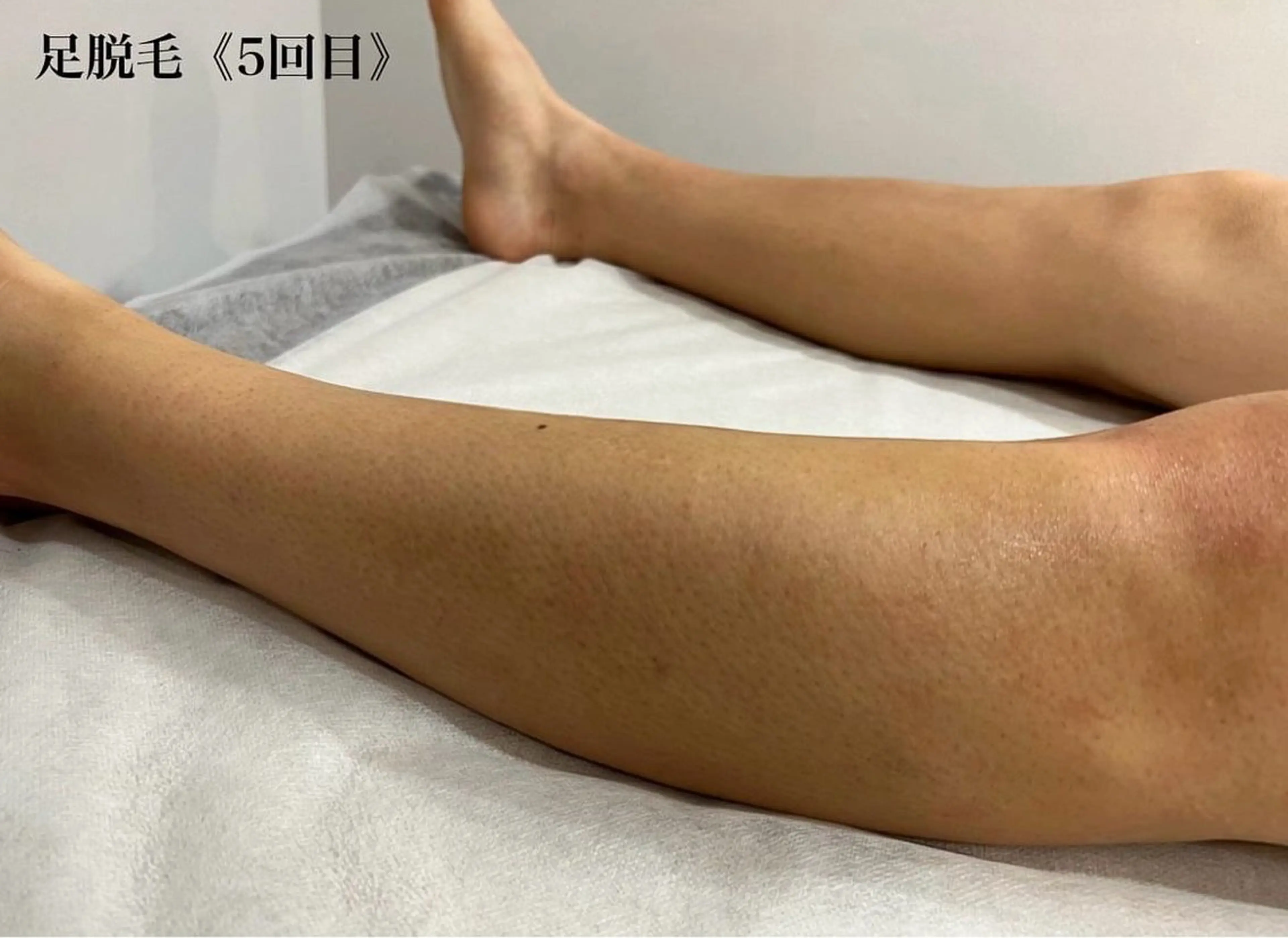 メンズ 脱毛 瀬戸 梨子のネイルデザイン