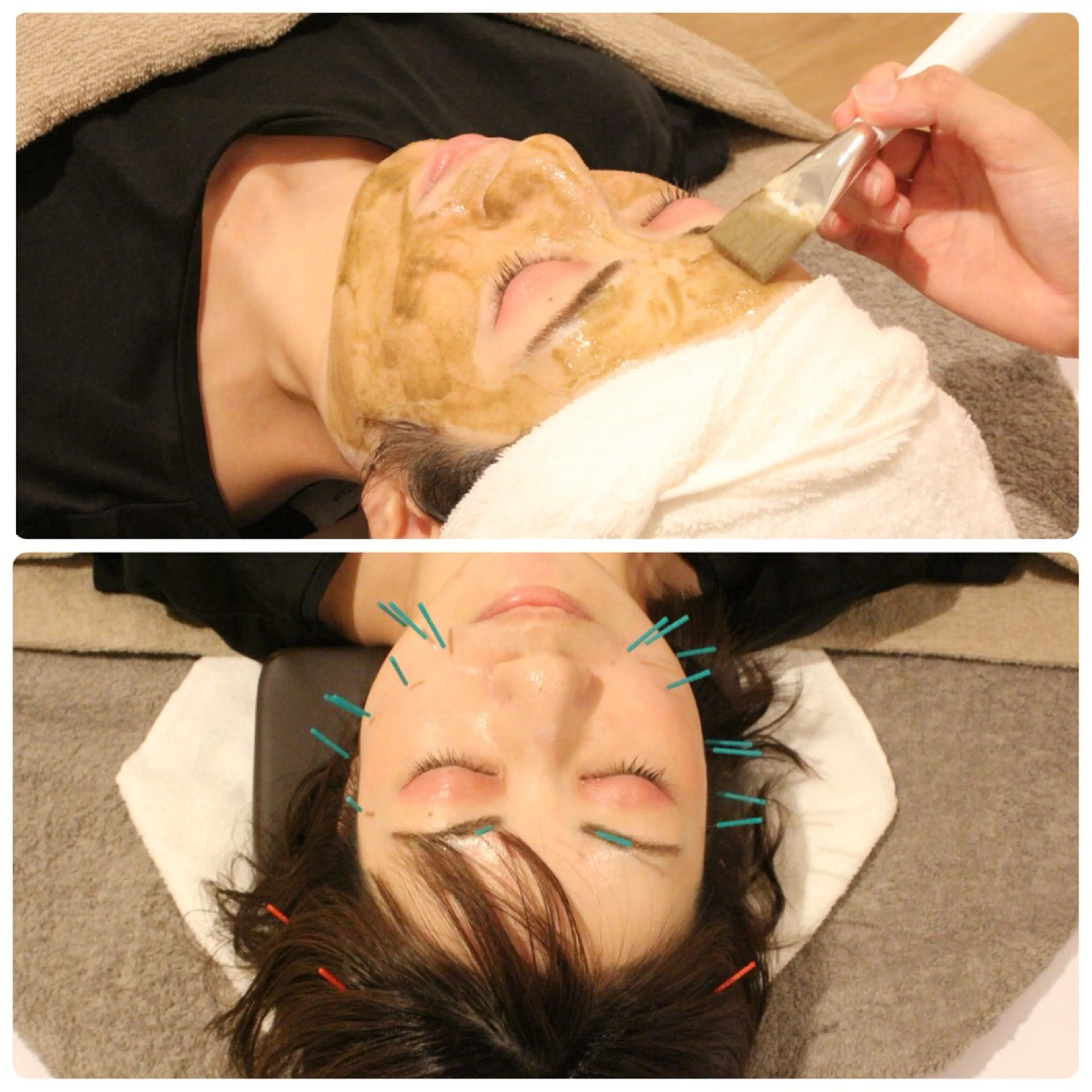 【にきび/毛穴ケア🌿】ハーブピーリング➕美容鍼➕ドライヘッドスパ　90分の写真