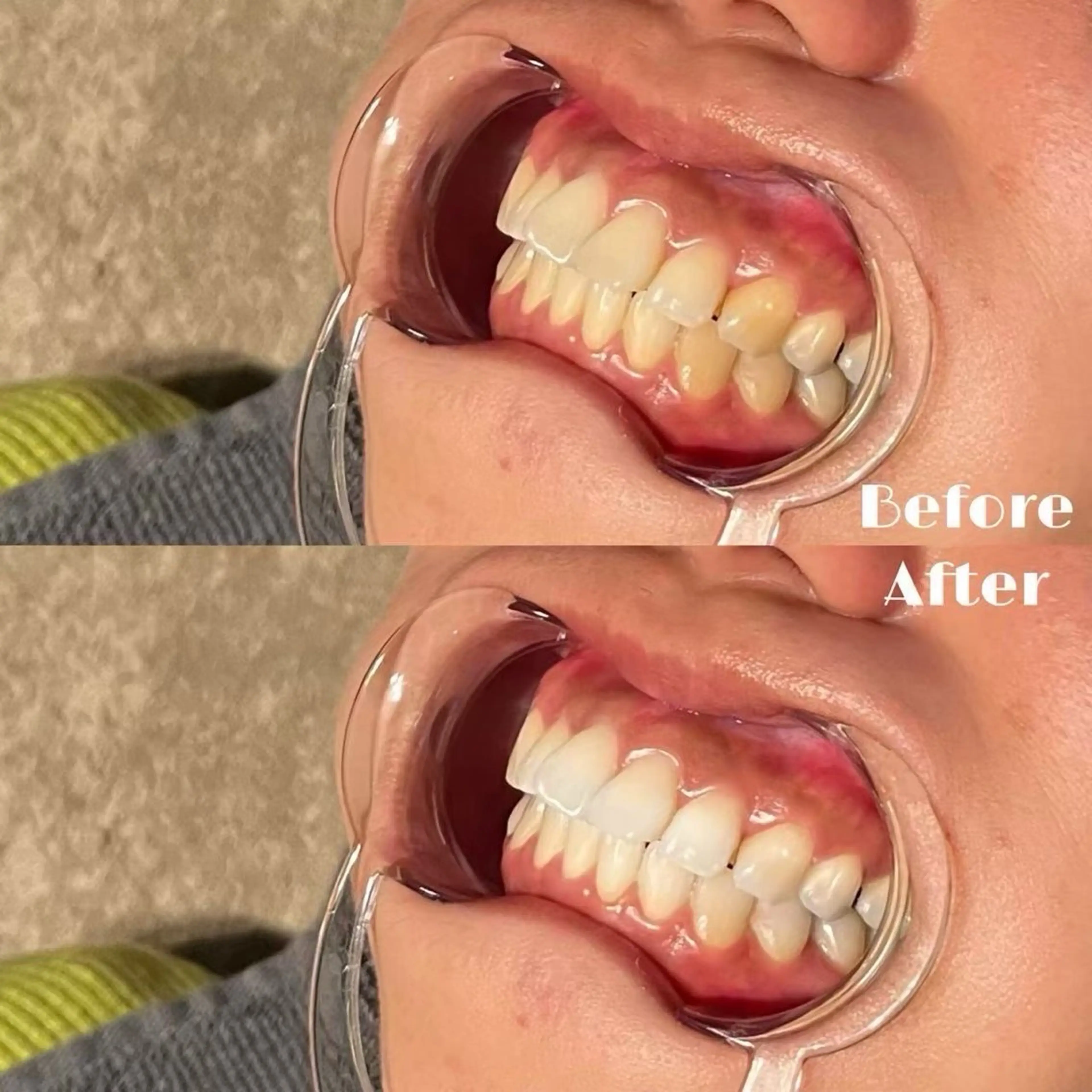 【第一印象UP】 ホワイトニングで理想の白い歯へ🦷✨の写真