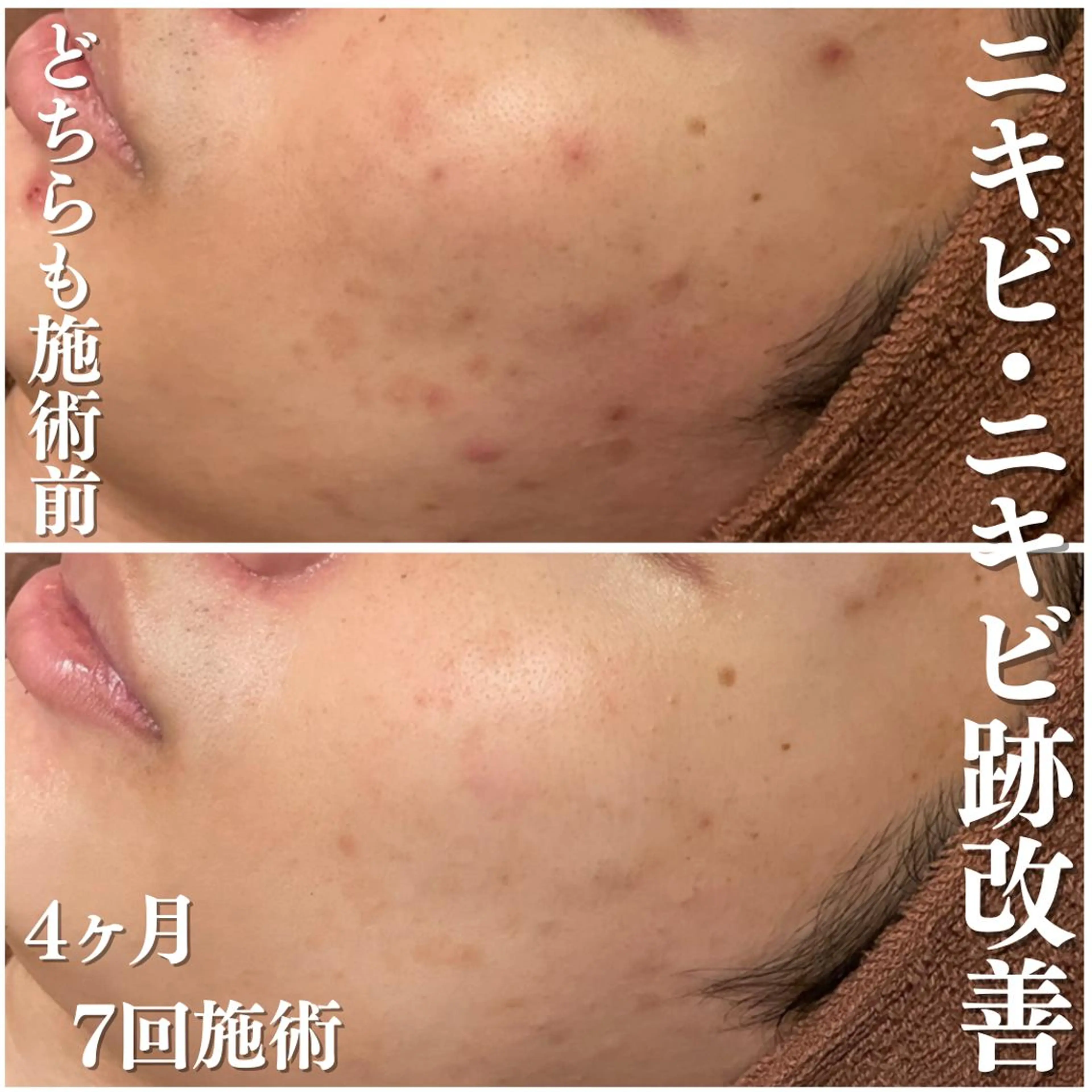 学生ニキビ改善🍀 優しい肌質改善のエステ・リラクイメージ