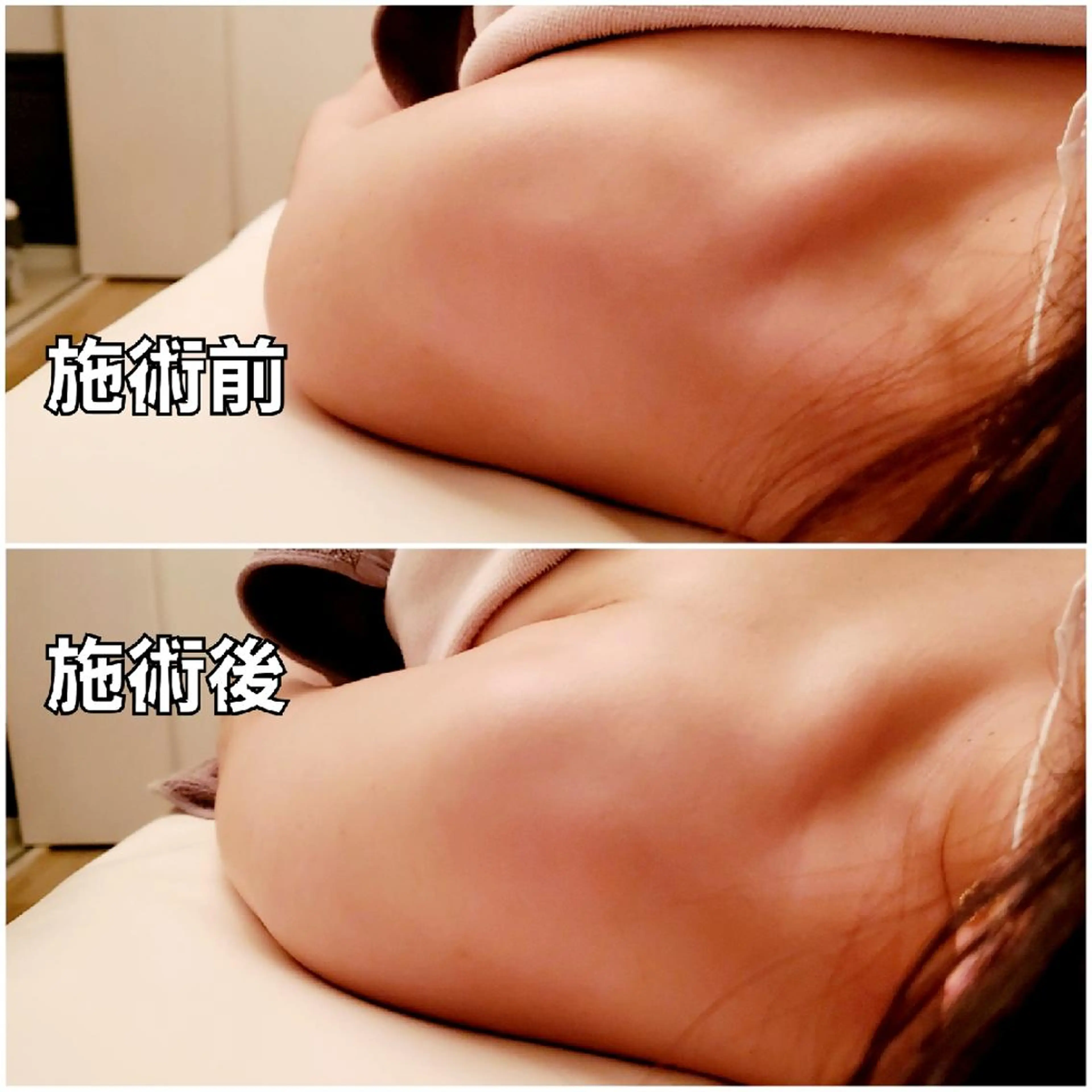 💗minimo限定【トリムハンド トリートメント】ヘッド付✨筋肉の歪み・捻れを整えて、肩こり/巻き肩/猫背/姿勢の改善の写真