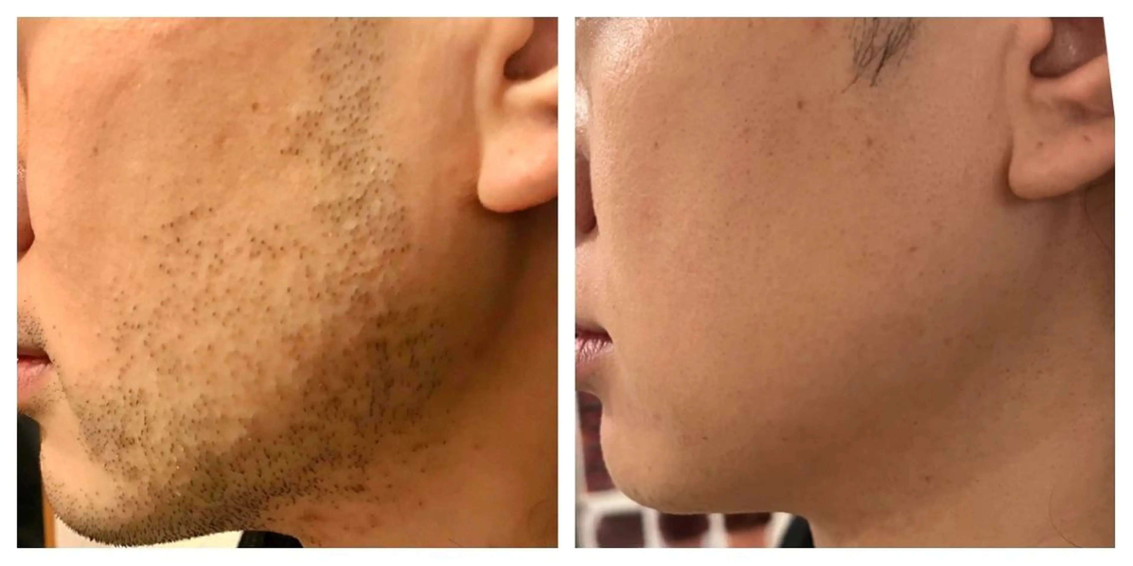 面倒なひげ剃りから解放！青ひげとサヨナラ【初回】〈メンズ〉ヒゲ脱毛  ¥3,000の写真