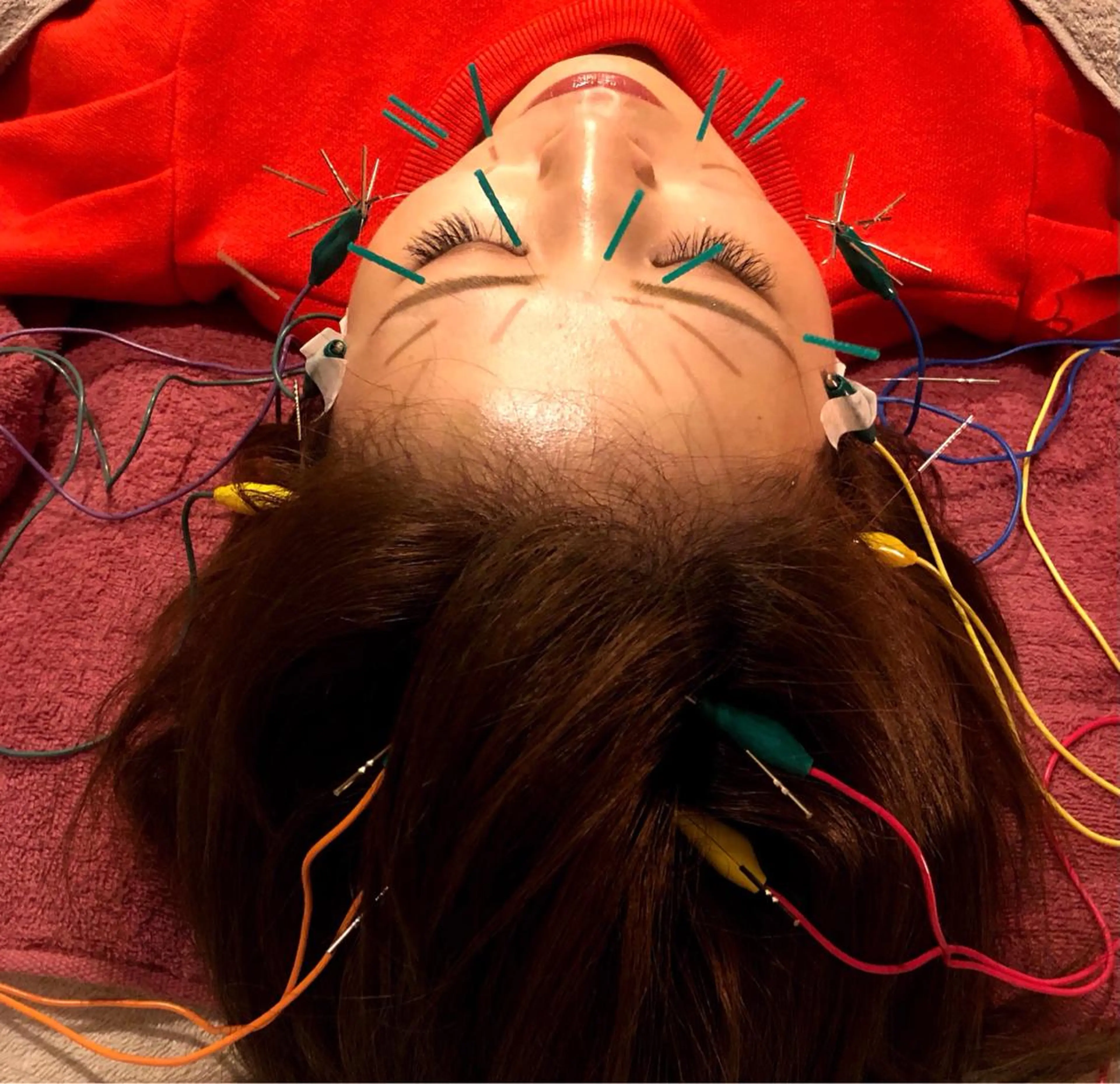 電気を流すちょっと激しめ美容鍼☞ あらゆるお悩みに対応して欲しい💕少し刺激が強くても大丈夫と言う方向け　マスク着用OKの写真