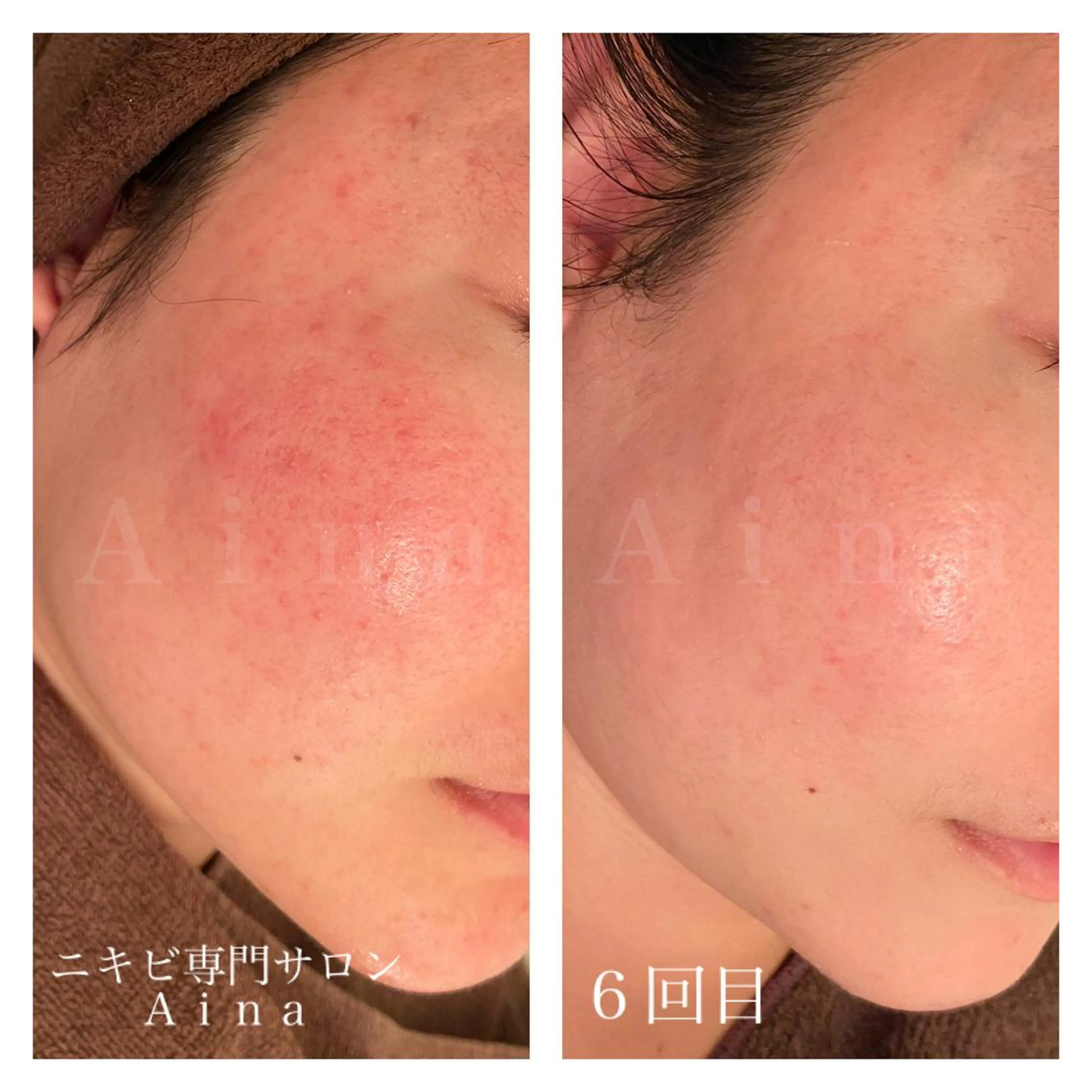 セミロング カラー パーマ ヘアアレンジ メンズ キッズ ネイル マツエク・マツパ ニキビ跡専門サロン Ａｉｎａのエステ・リラクイメージ