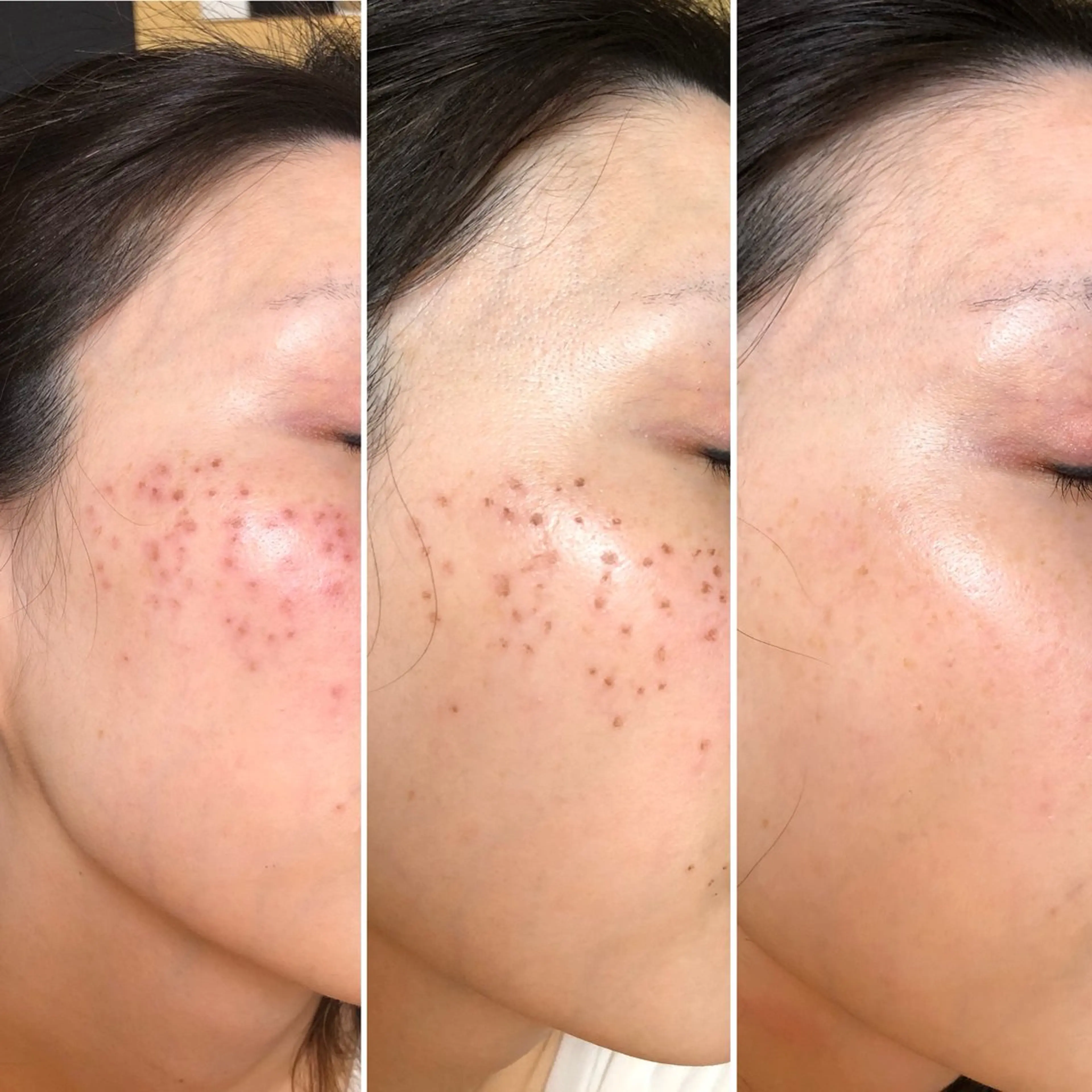 しみ取りなら冬の間に⛄️ダウンタイム1週間！保護テープなし❣️傷みなし❣️の写真