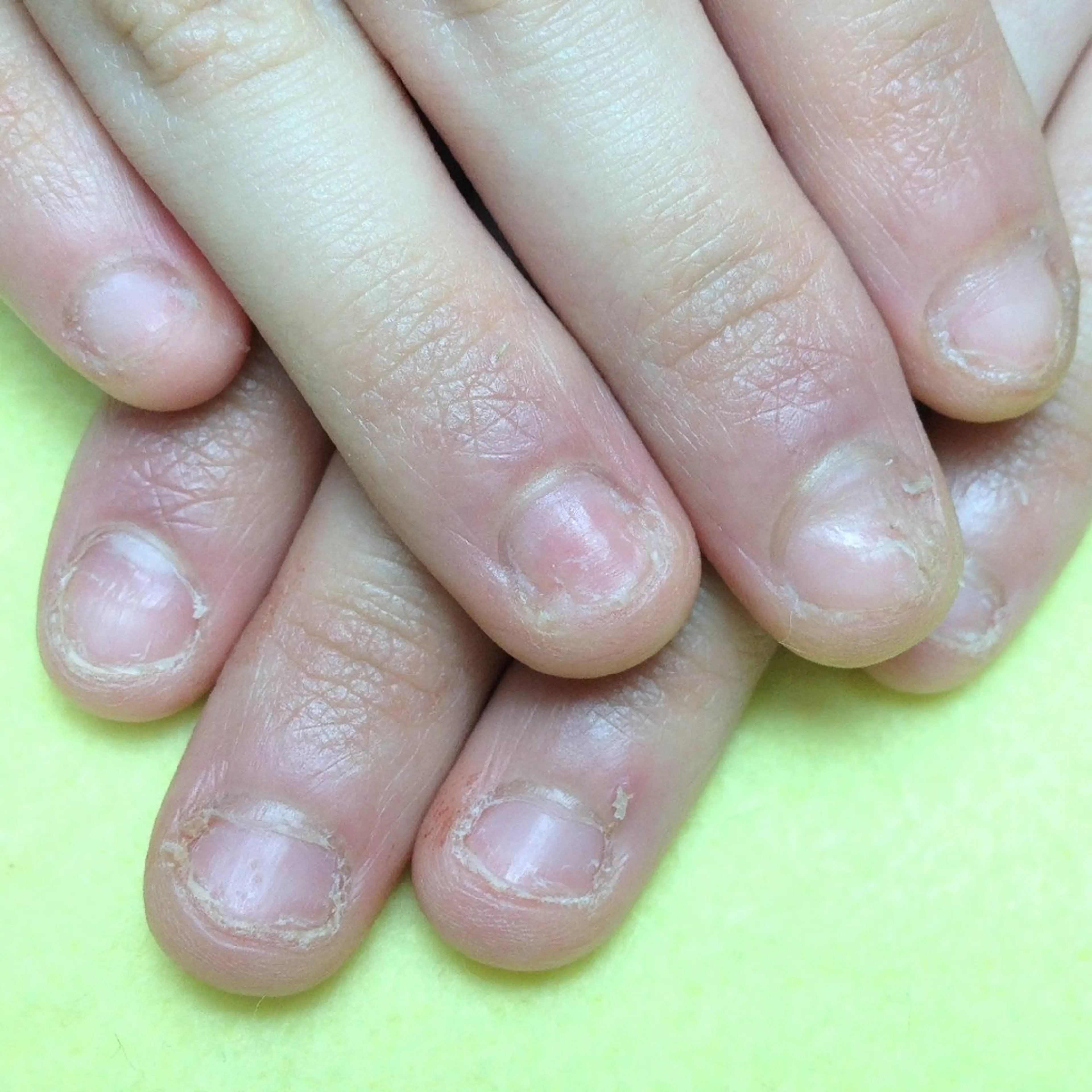 ネイル ハンドネイル ハンドケア 深爪矯正/爪育成ケア manie nailのネイルデザイン