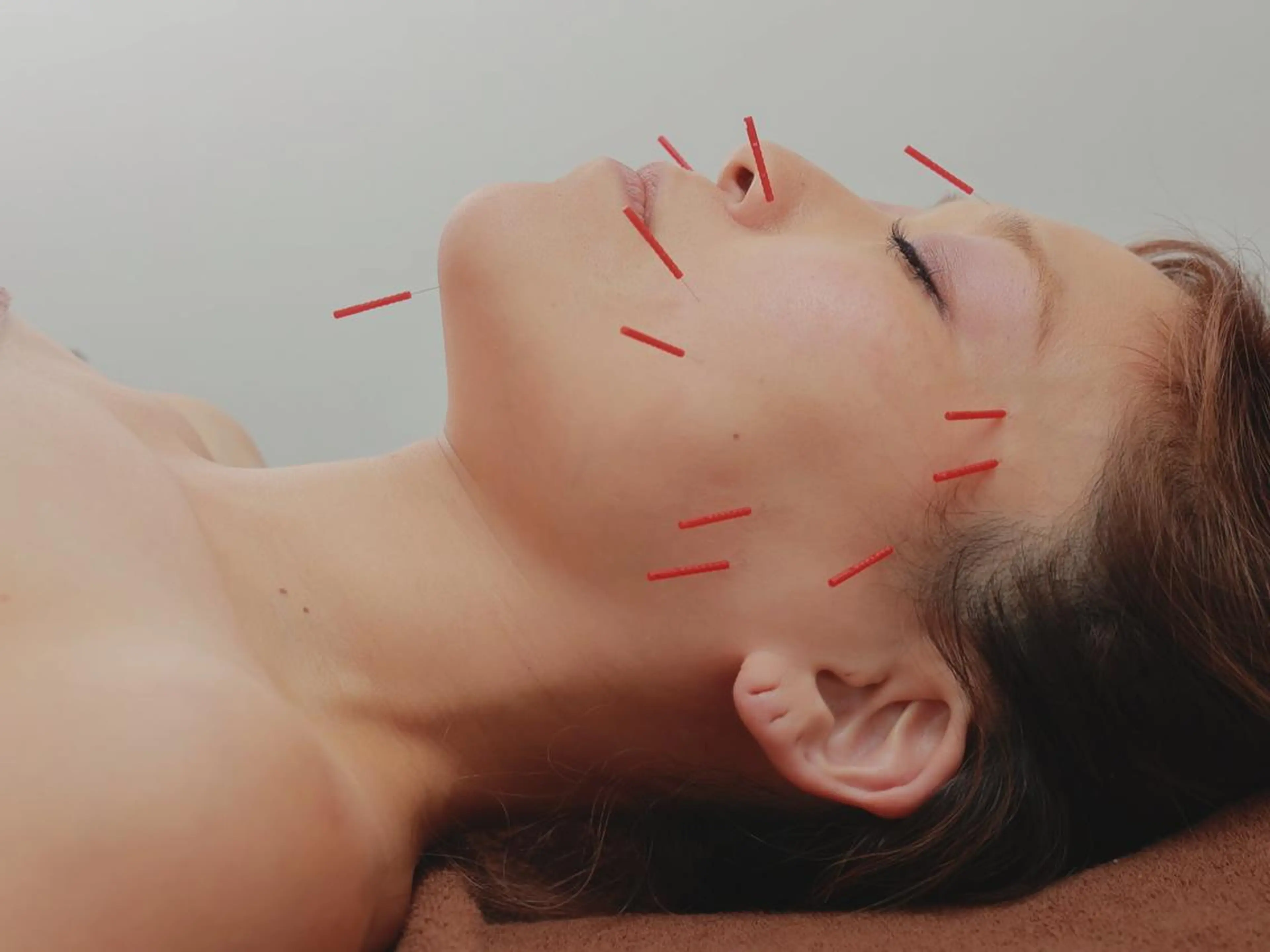 【美容鍼】初回お試しの写真