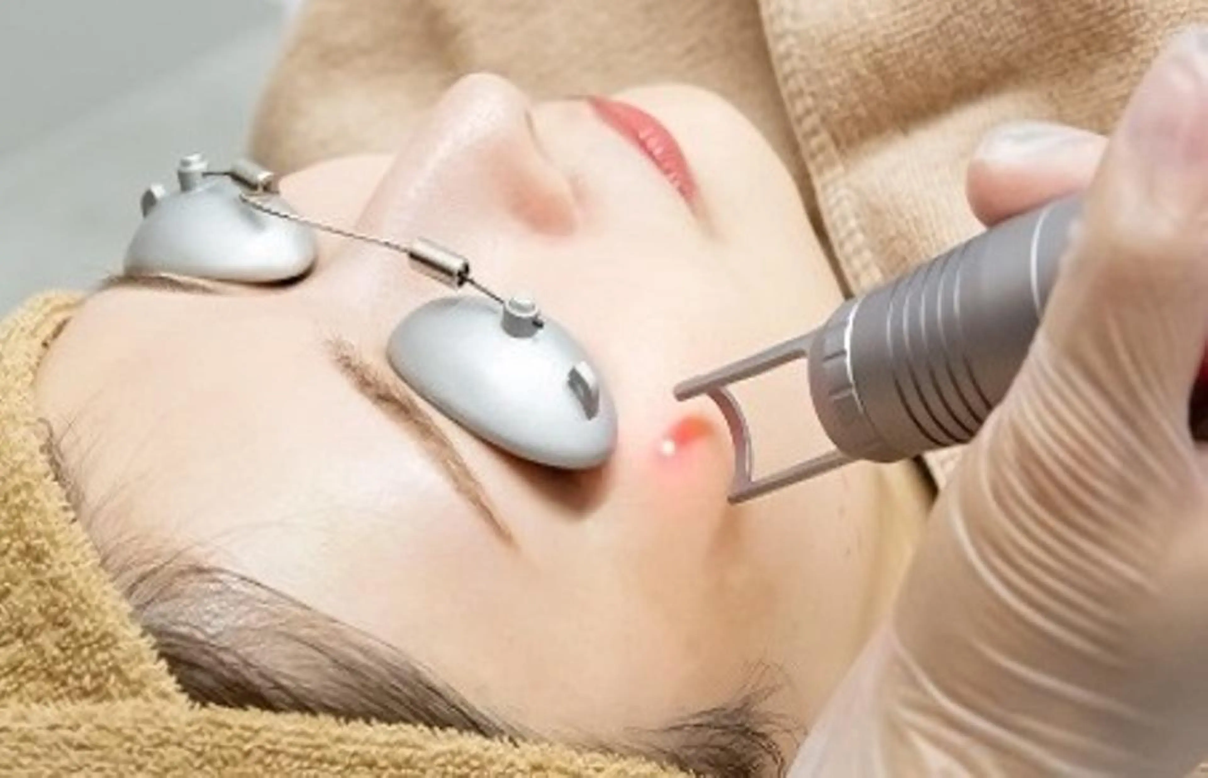 エステの不可能を【シミ専門ケア】laser ＊数回で完了の写真