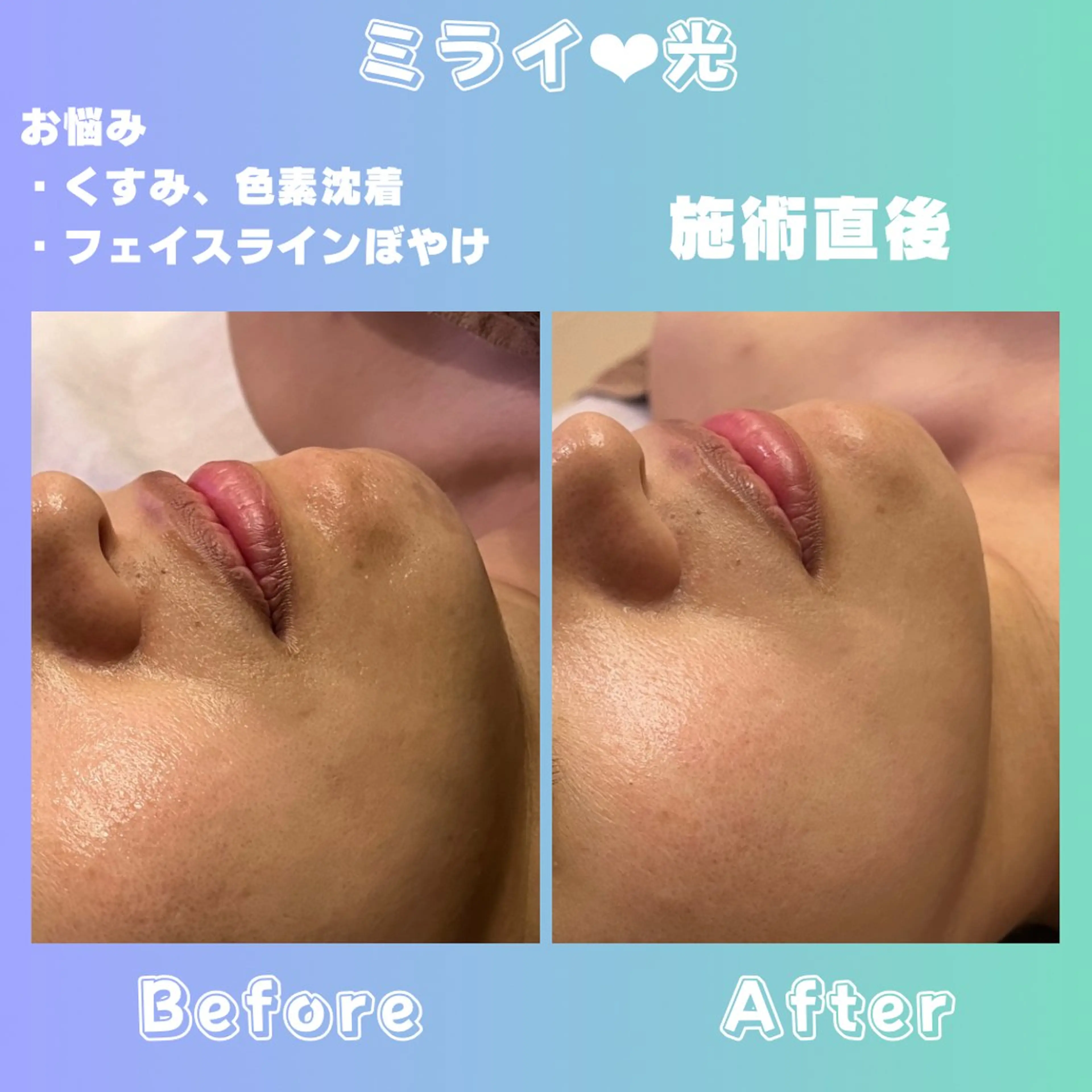 🩵もっちりちゅるん肌🩵時短で頬、口角キュッと小顔フェイスラインくっきり🫧ミライの光と特殊ジェル🍊で効果持続✨️の写真