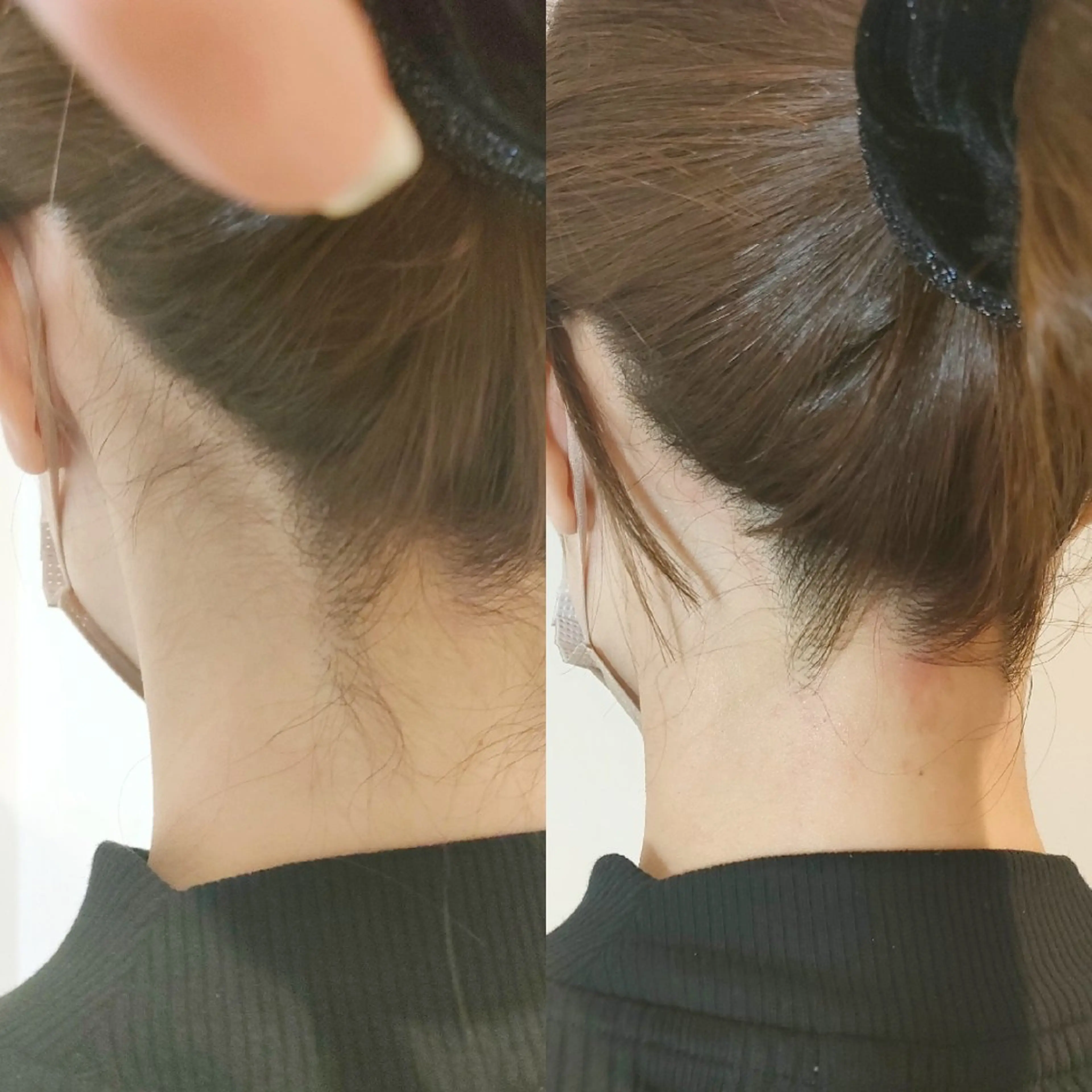 うなじワックス脱毛＋高速光脱毛(ダブル脱毛)の写真