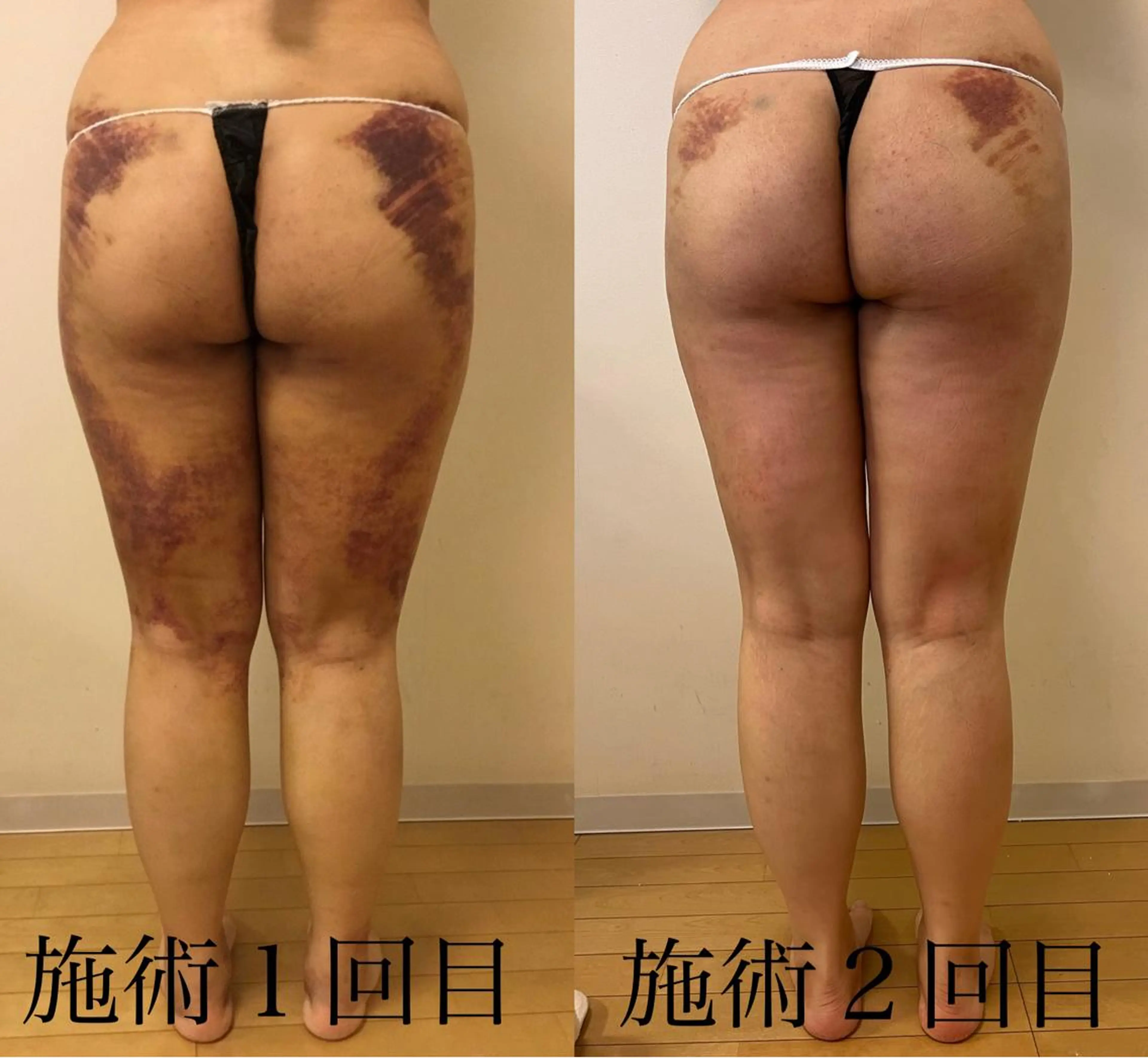 【術後モニター】施術部位の写真撮影有◎インディバ60分通常¥15,000→¥10,000フェイシャル、大腿、腹腰、二の腕の写真