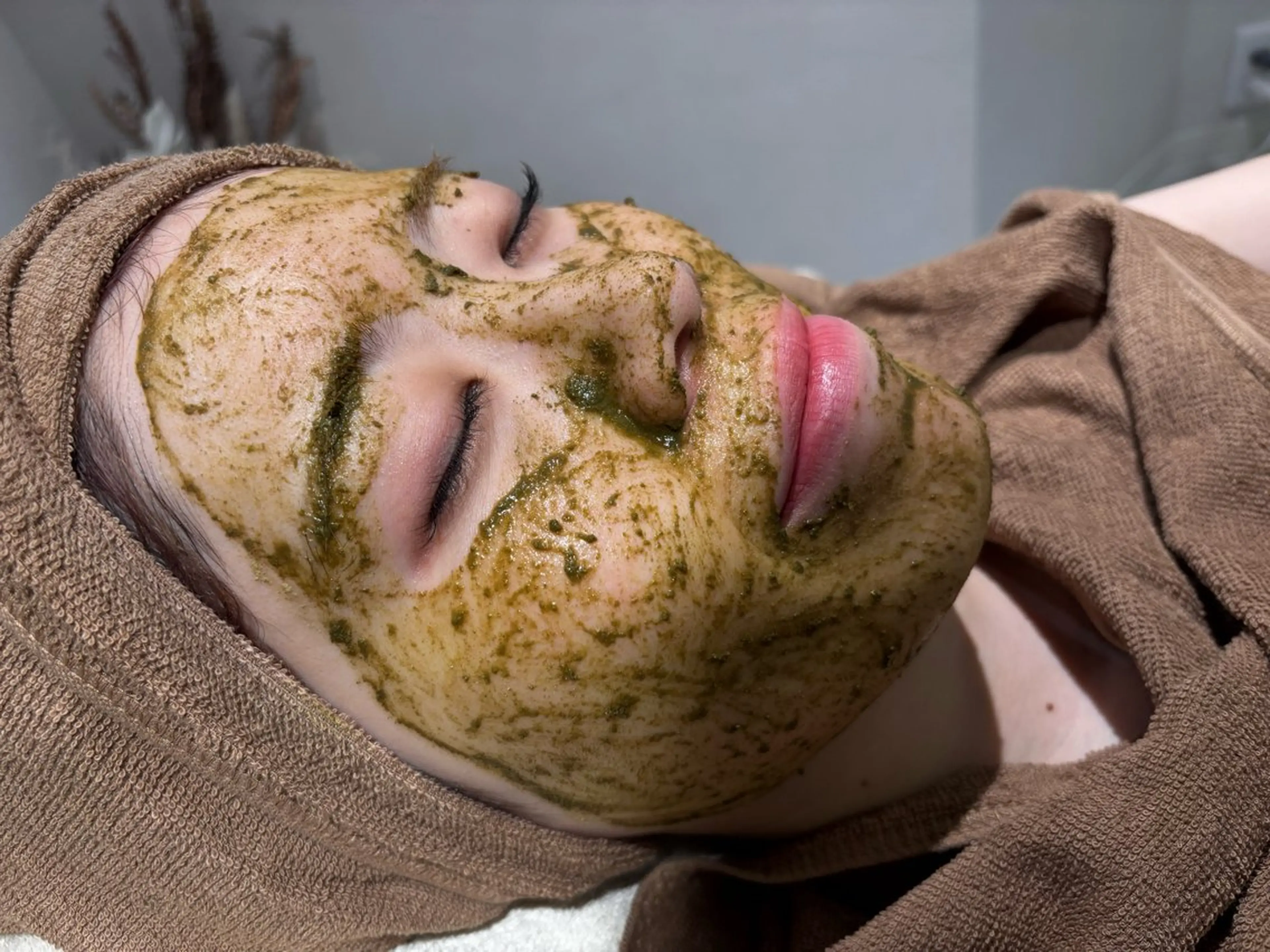 ✨特別クーポン✨【ニキビ肌】ハーブピーリング🌿(剥離あり)の写真