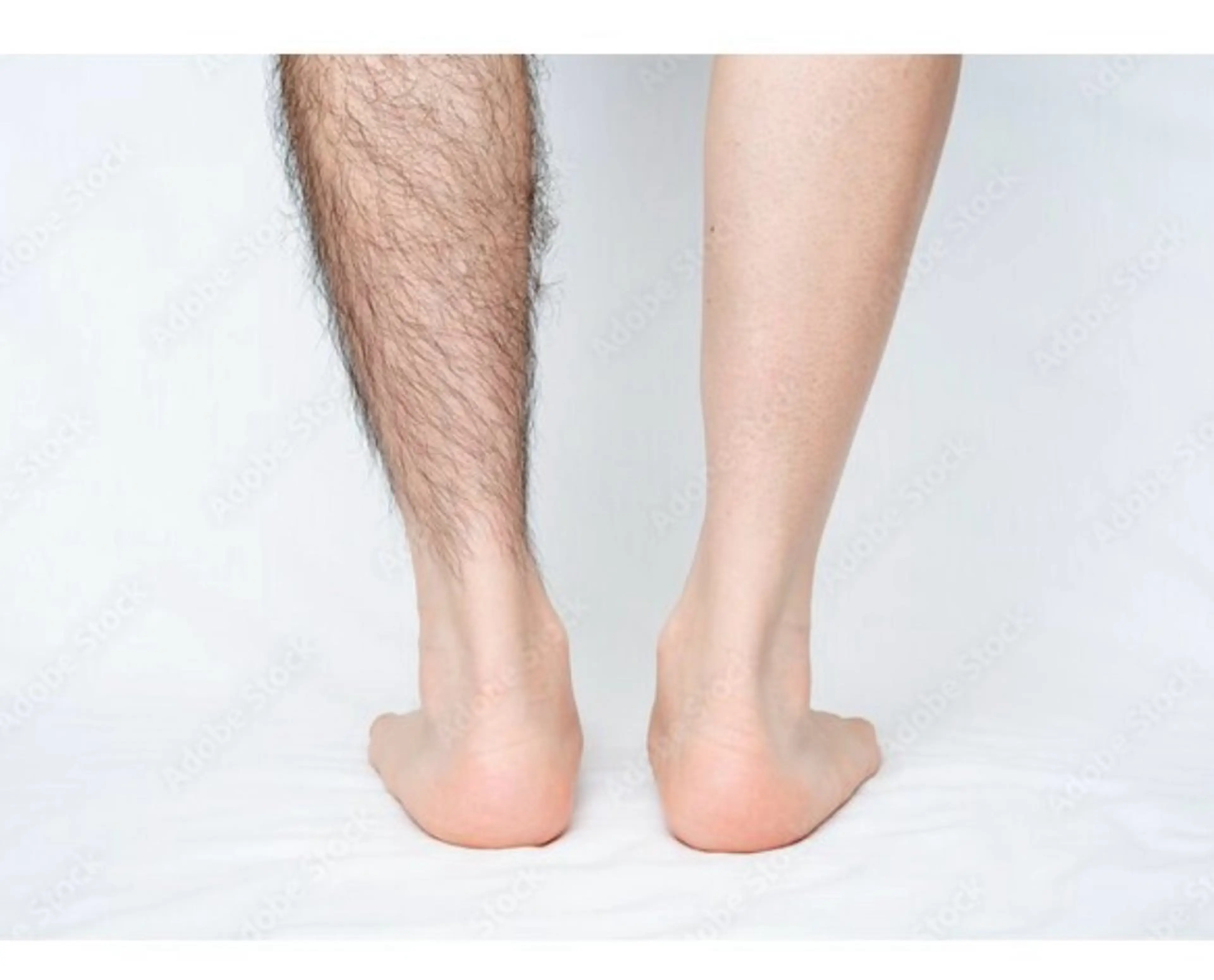 【メンズ脱毛🌈 】あし脱毛(太もも~ふくらはぎ~足の甲指)🙆‍♂️通常9800円→初回6,600円の写真