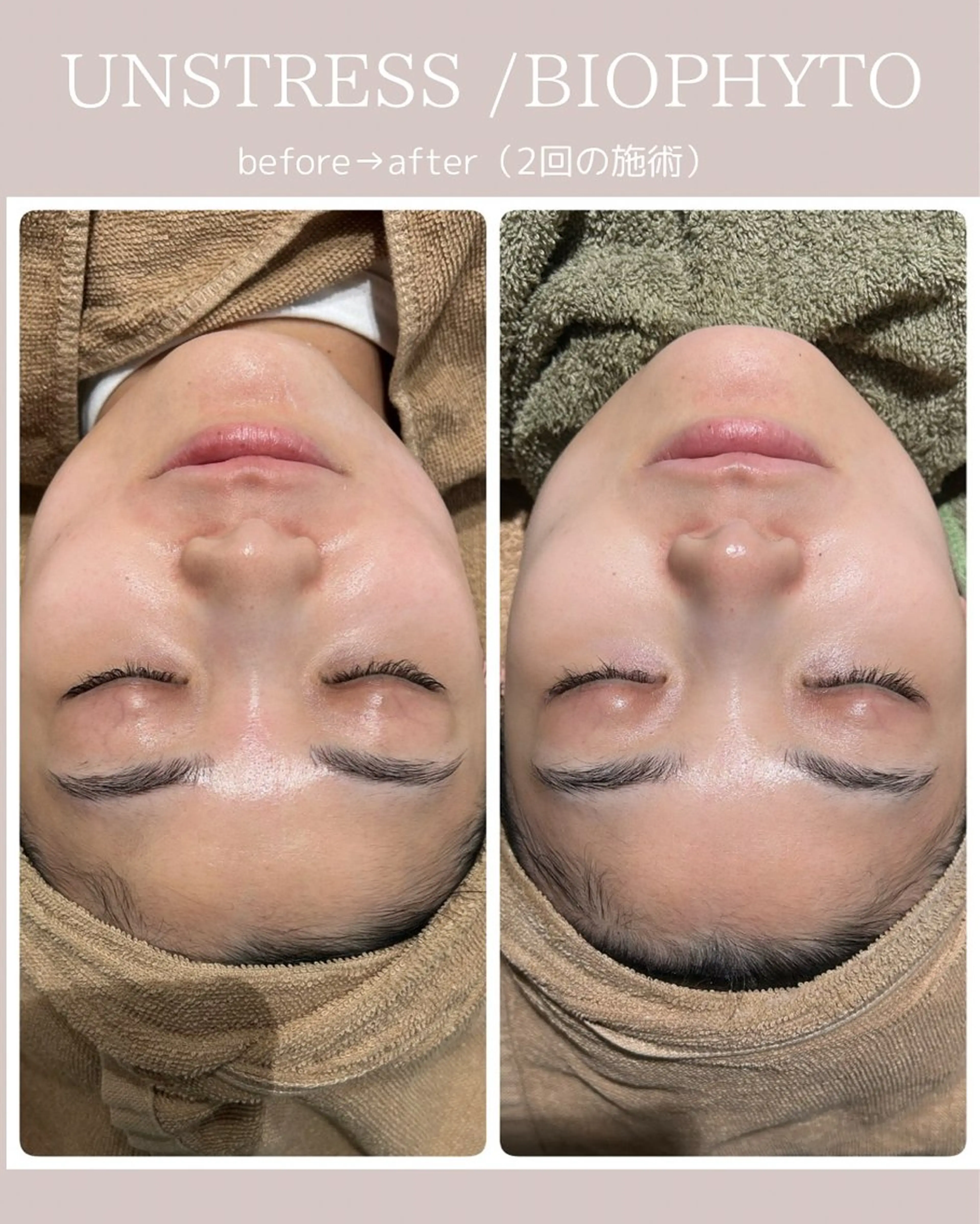 【毛穴•ハーブピーリング】 ニキビ対策サロンétoile クリスティーナ正規取扱店所属・松尾 佳奈のエステ・リラクイメージ