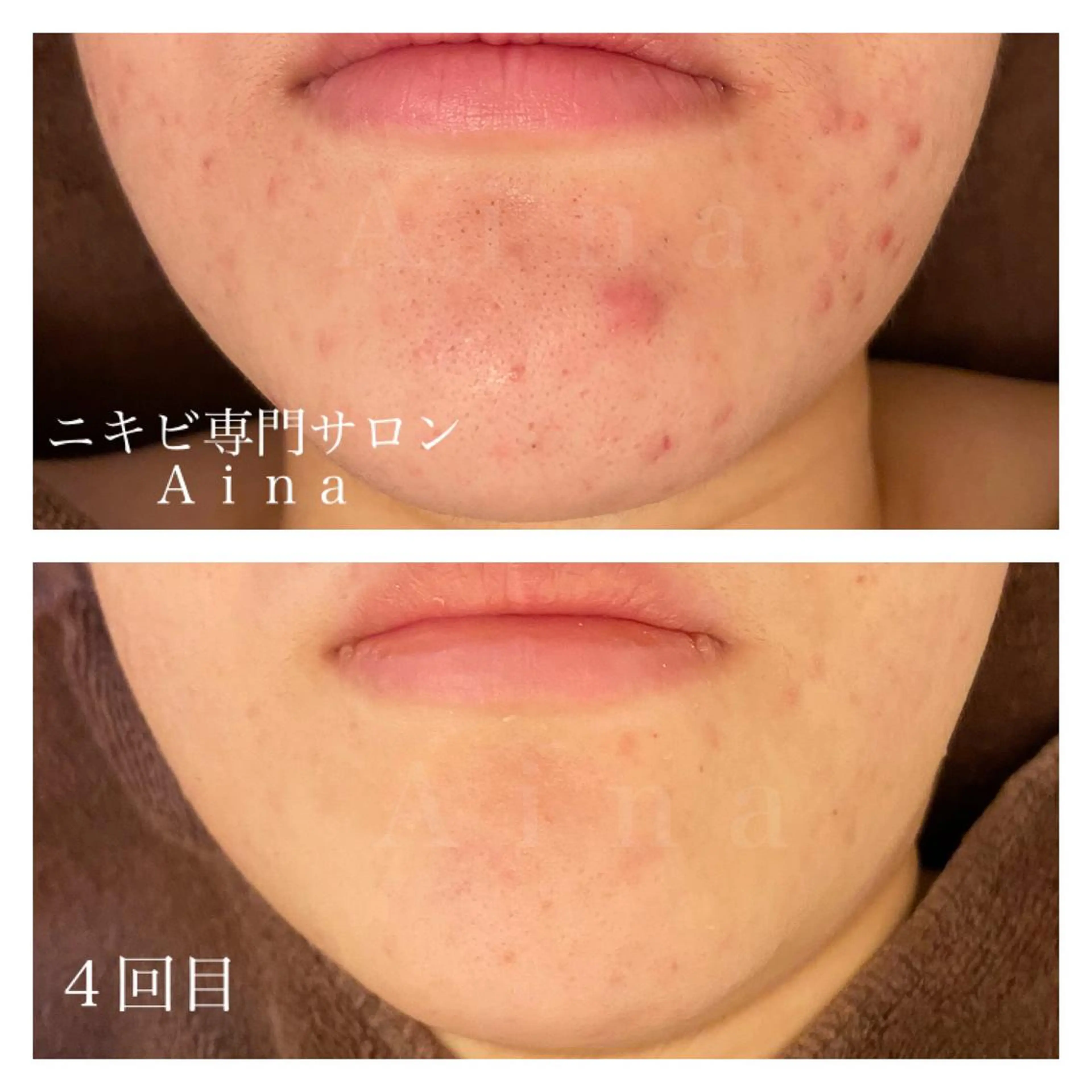 セミロング カラー パーマ ヘアアレンジ メンズ キッズ ネイル マツエク・マツパ ニキビ跡専門サロン Ａｉｎａのエステ・リラクイメージ