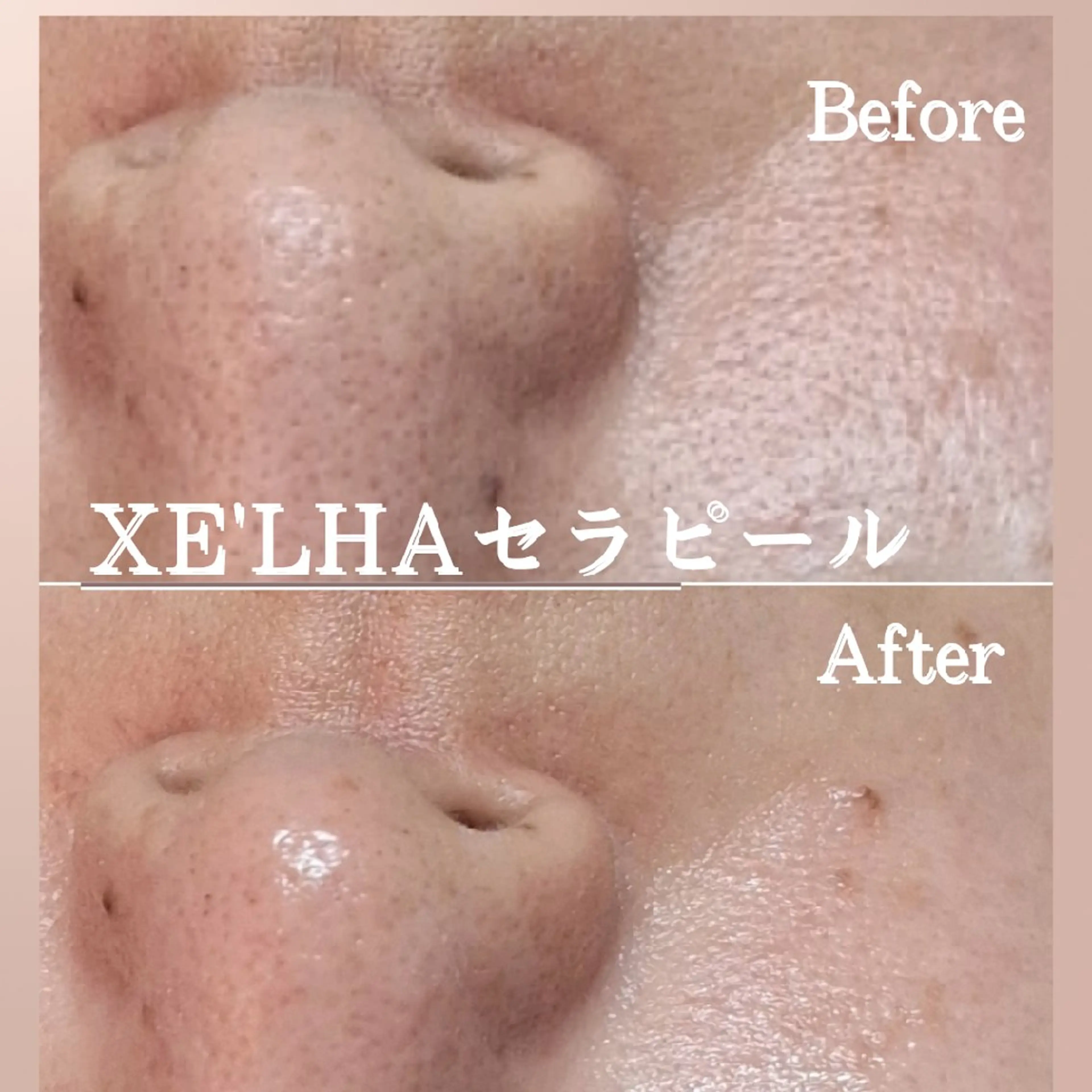 【セラピール】LHA進化版/美白ピーリングで白玉肌に！の写真