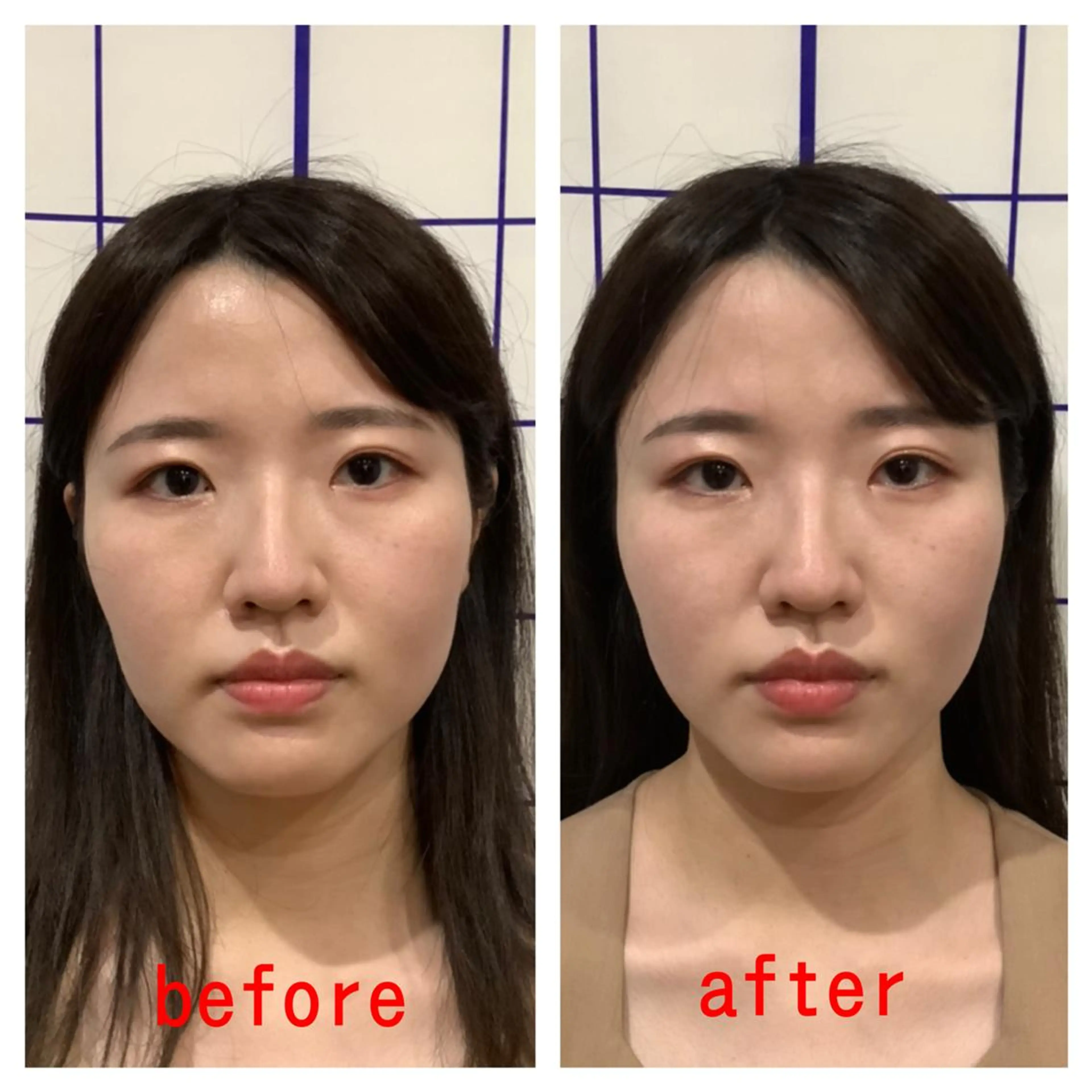 エステ リラク お顔のむくみたるみ 専門☆美容鍼小顔矯正のエステ・リラクイメージ