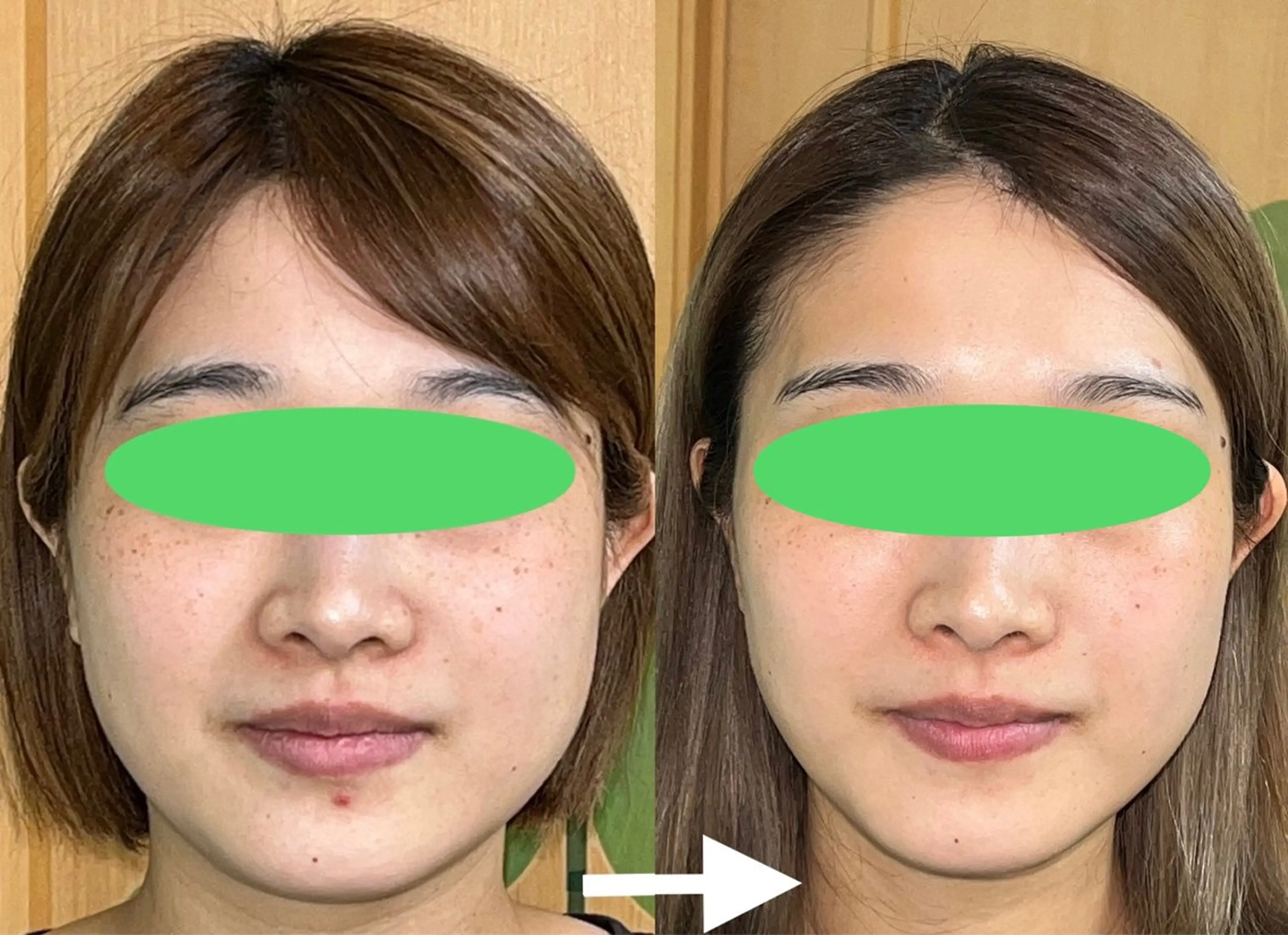 理想のフェイスラインで鏡を見るのが楽しくなる✨小顔矯正+美顔トリートメント　60分の写真