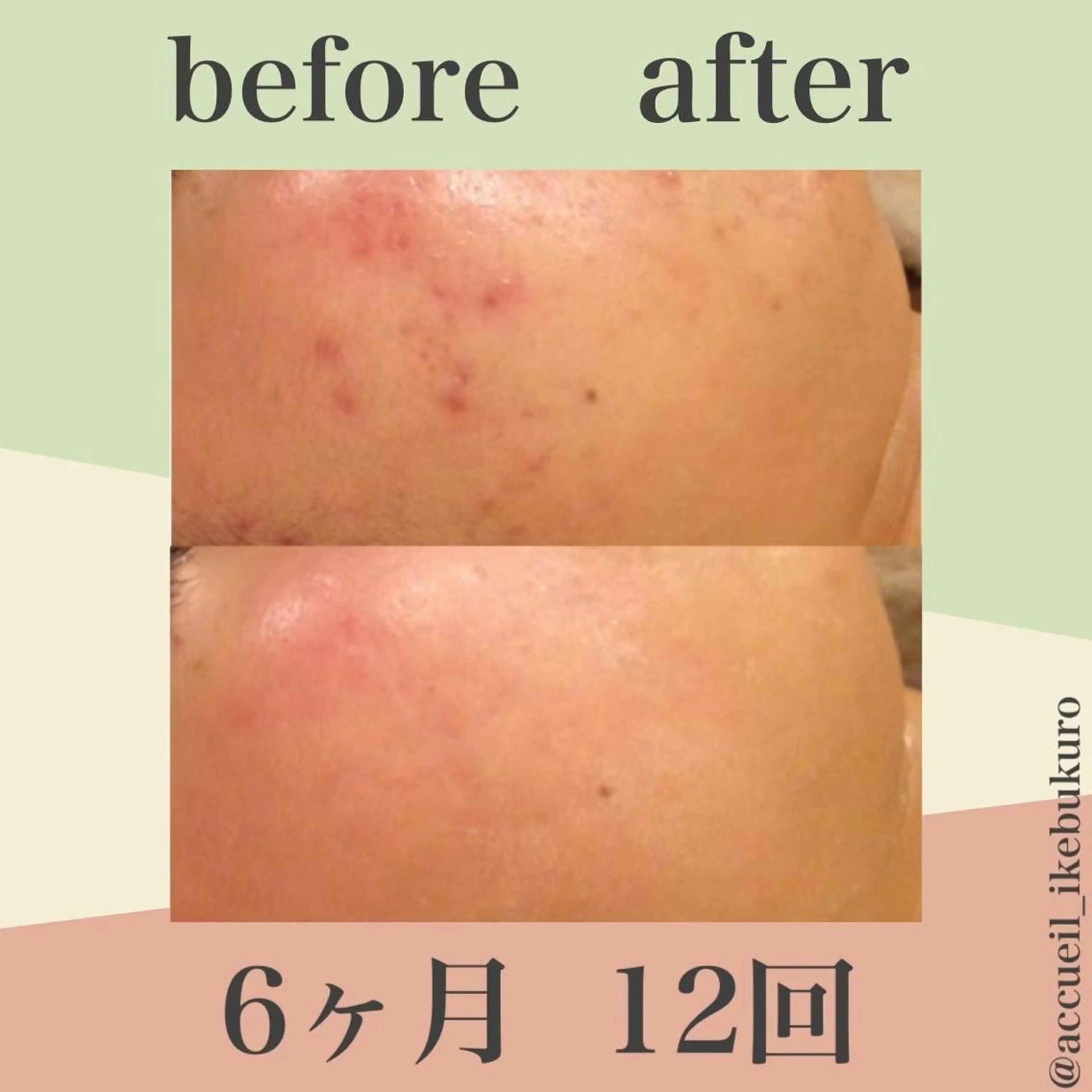 ミディアム カラー パーマ ヘアアレンジ メンズ キッズ ネイル マツエク・マツパ エステ リラク ニキビ・肌質改善専門 ♡人生が変わるサロンのエステ・リラクイメージ