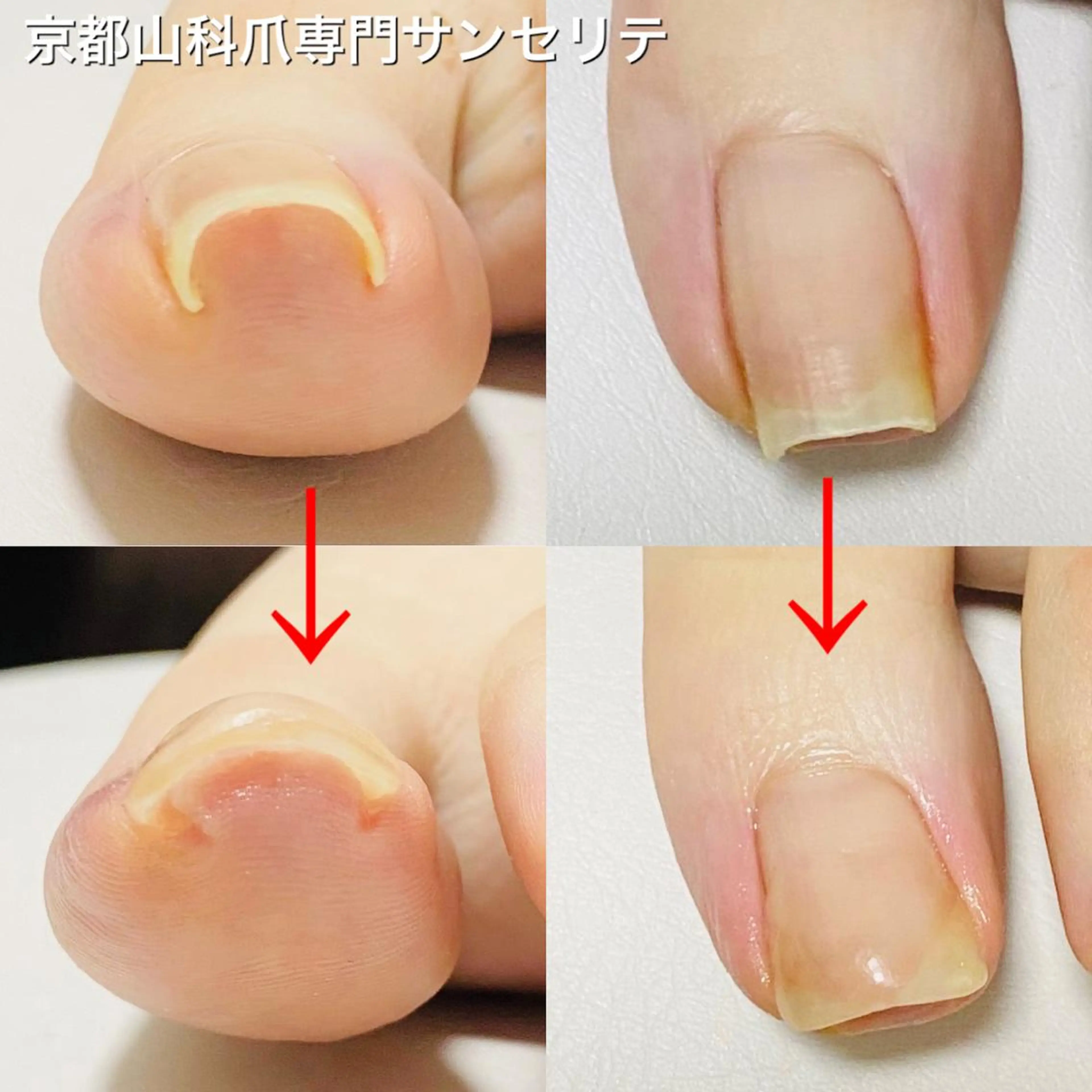 ネイル 深爪・巻き爪 専門サンセリテのネイルデザイン