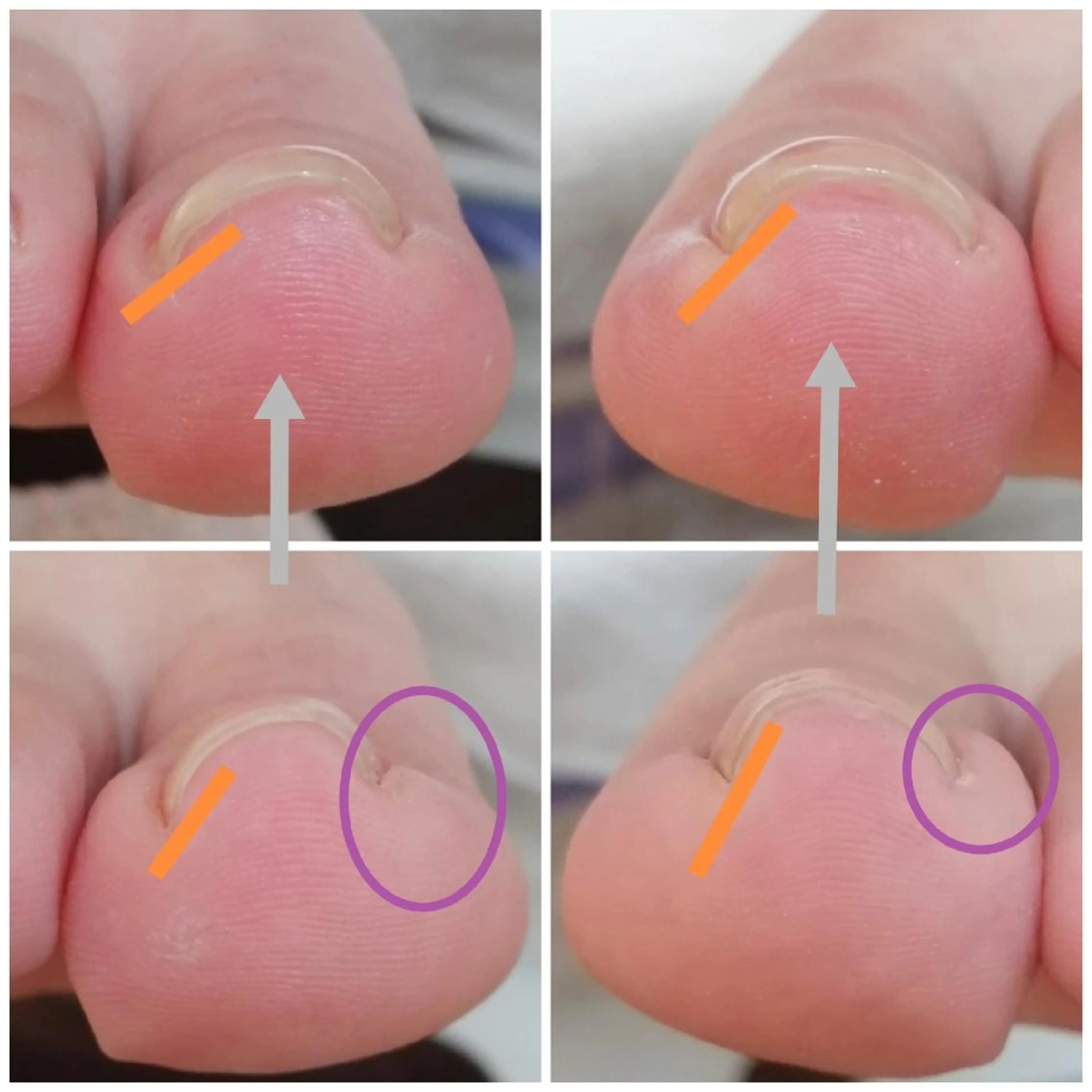 痛みなし！巻き爪ケアジェルお試し1本の写真