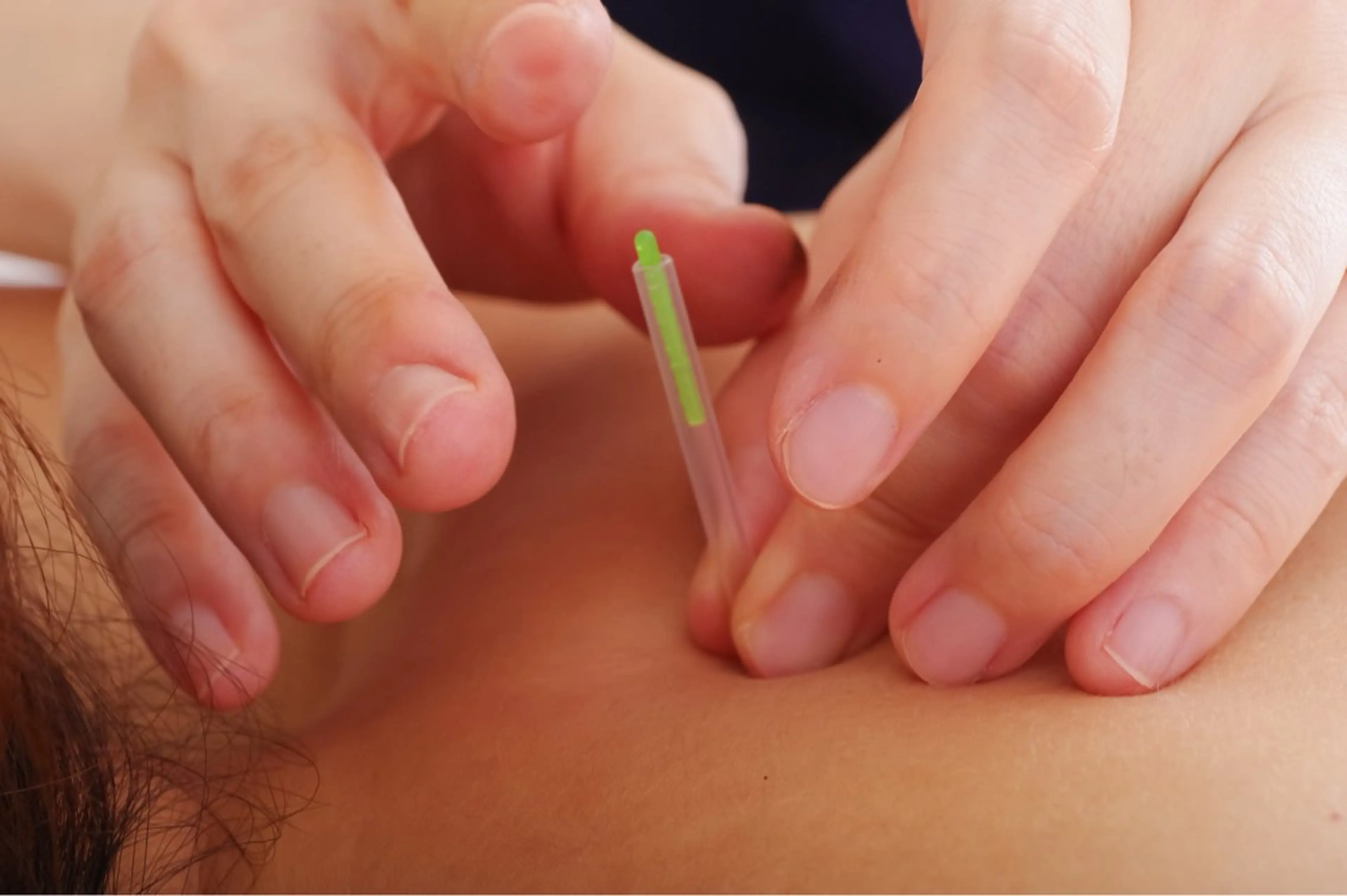 🌸【モデル募集】腰痛鍼灸コースの写真