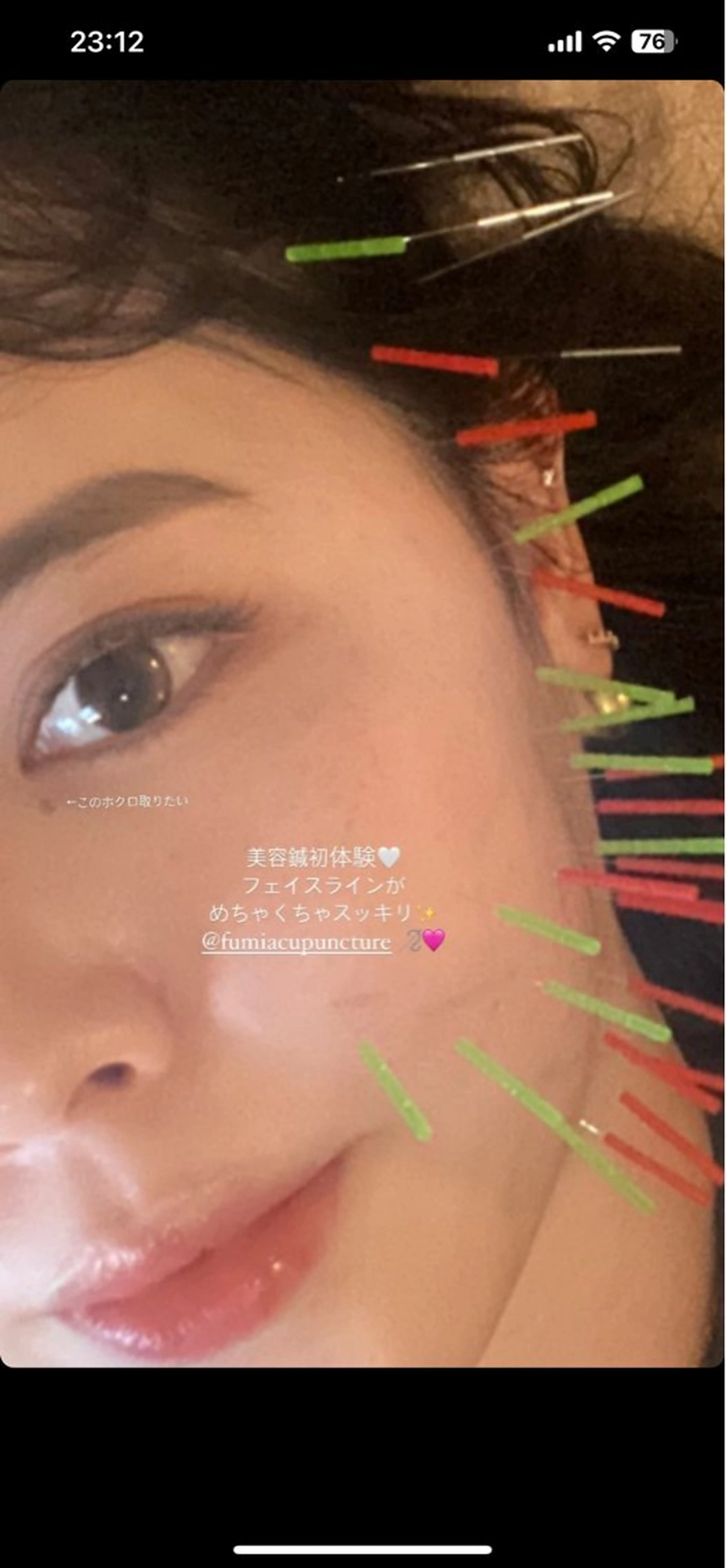 THE  ROOTS所属・美容鍼♡小顔矯正♡ fumikaのエステ・リラクイメージ