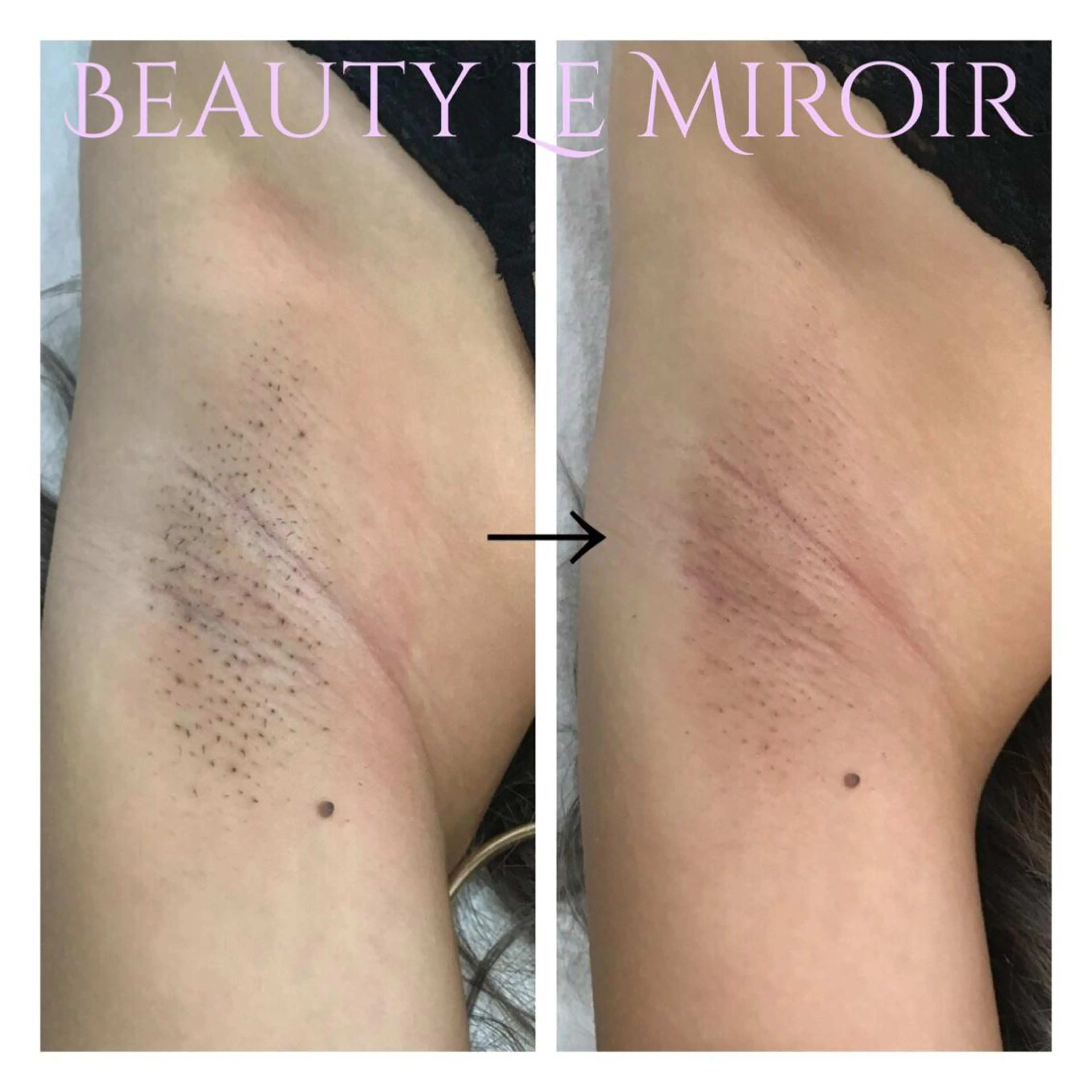 脱毛 ビューティー ミロワールのエステ・リラクイメージ