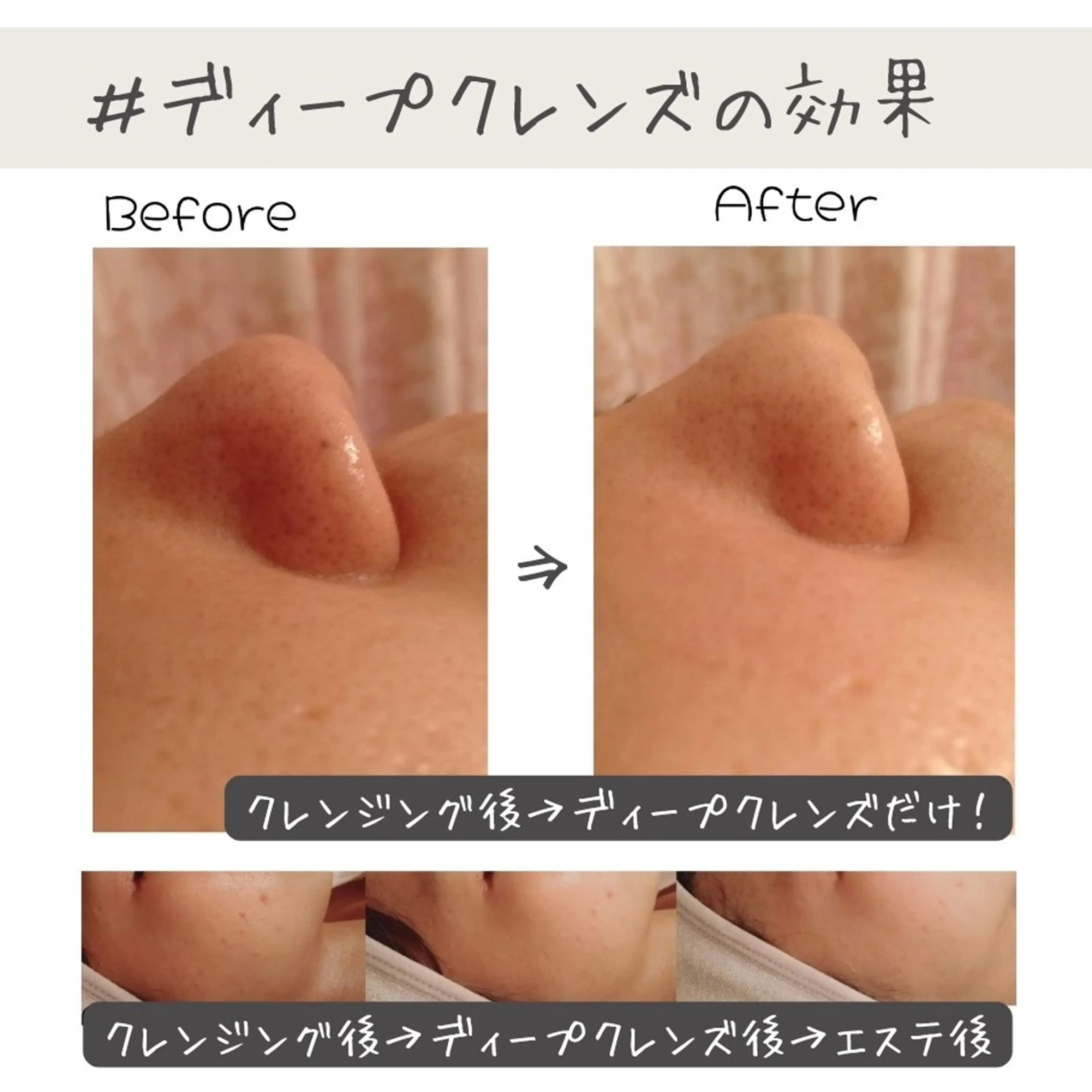 【人気No.1】超音波毛穴洗浄モニター✨️の写真