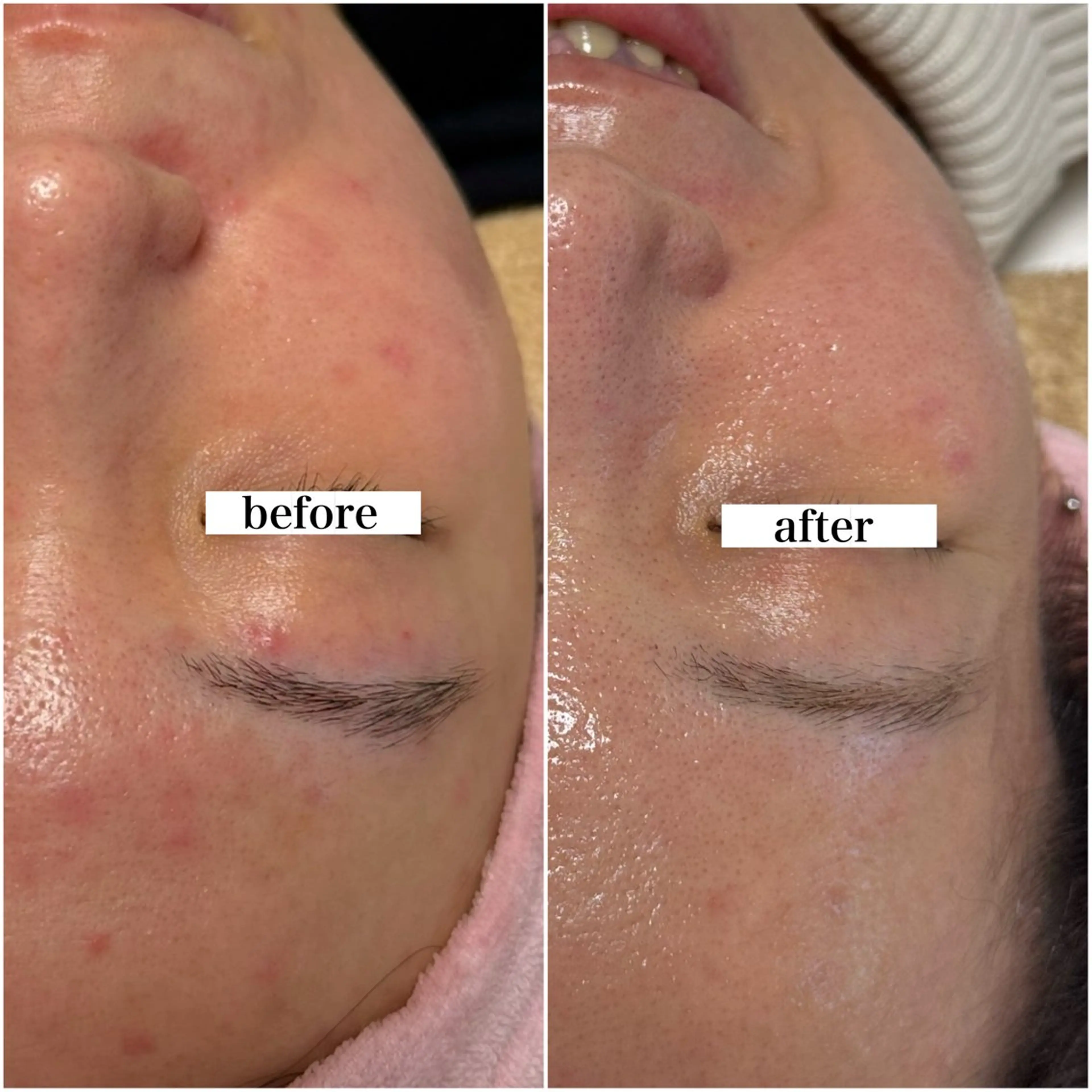 🩵minimoセール🩵【 プラズマ×ポレーション 】重度ニキビ/ニキビ跡の写真