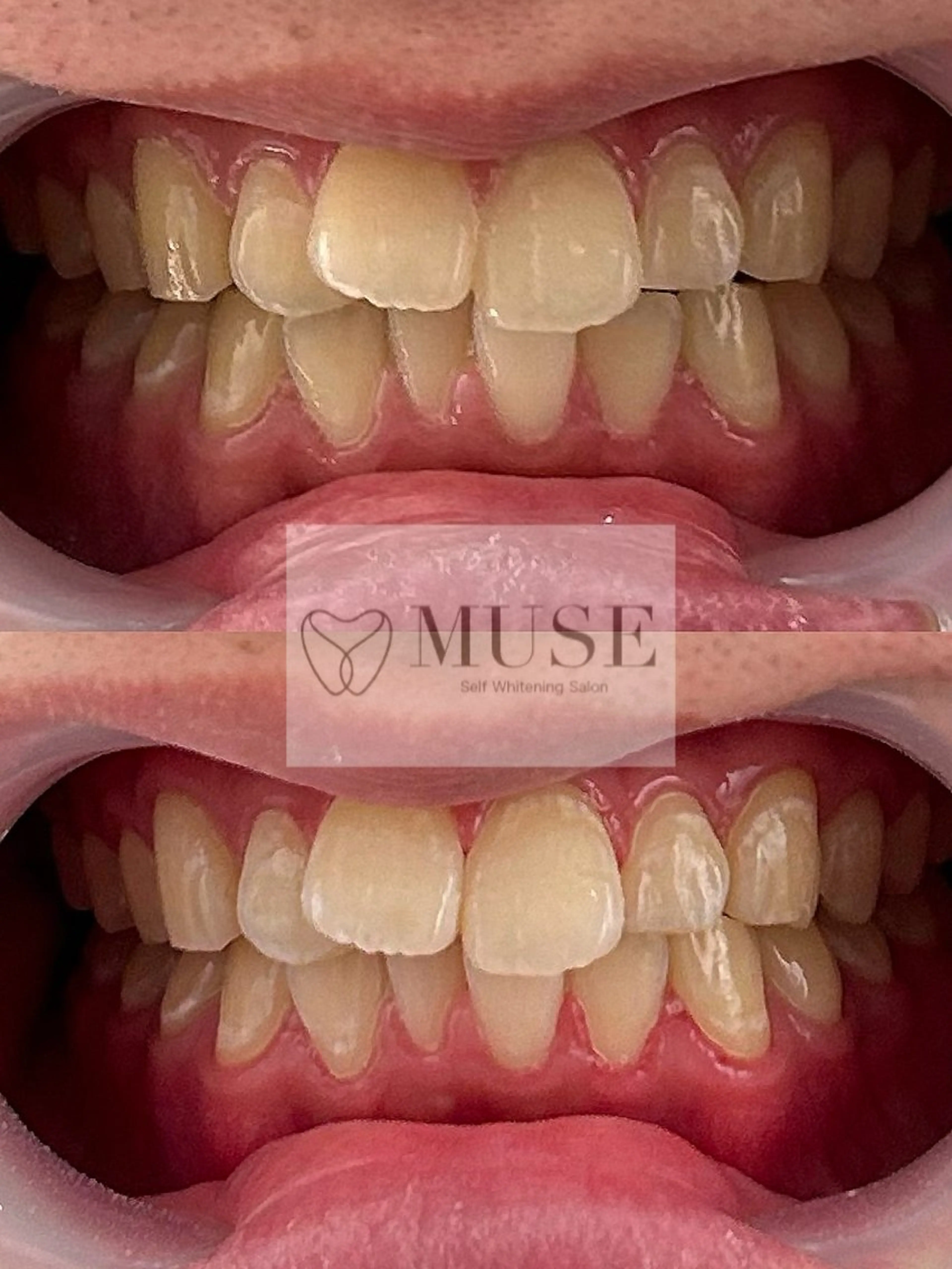 歯のセルフホワイトニング◎お試し8分の写真