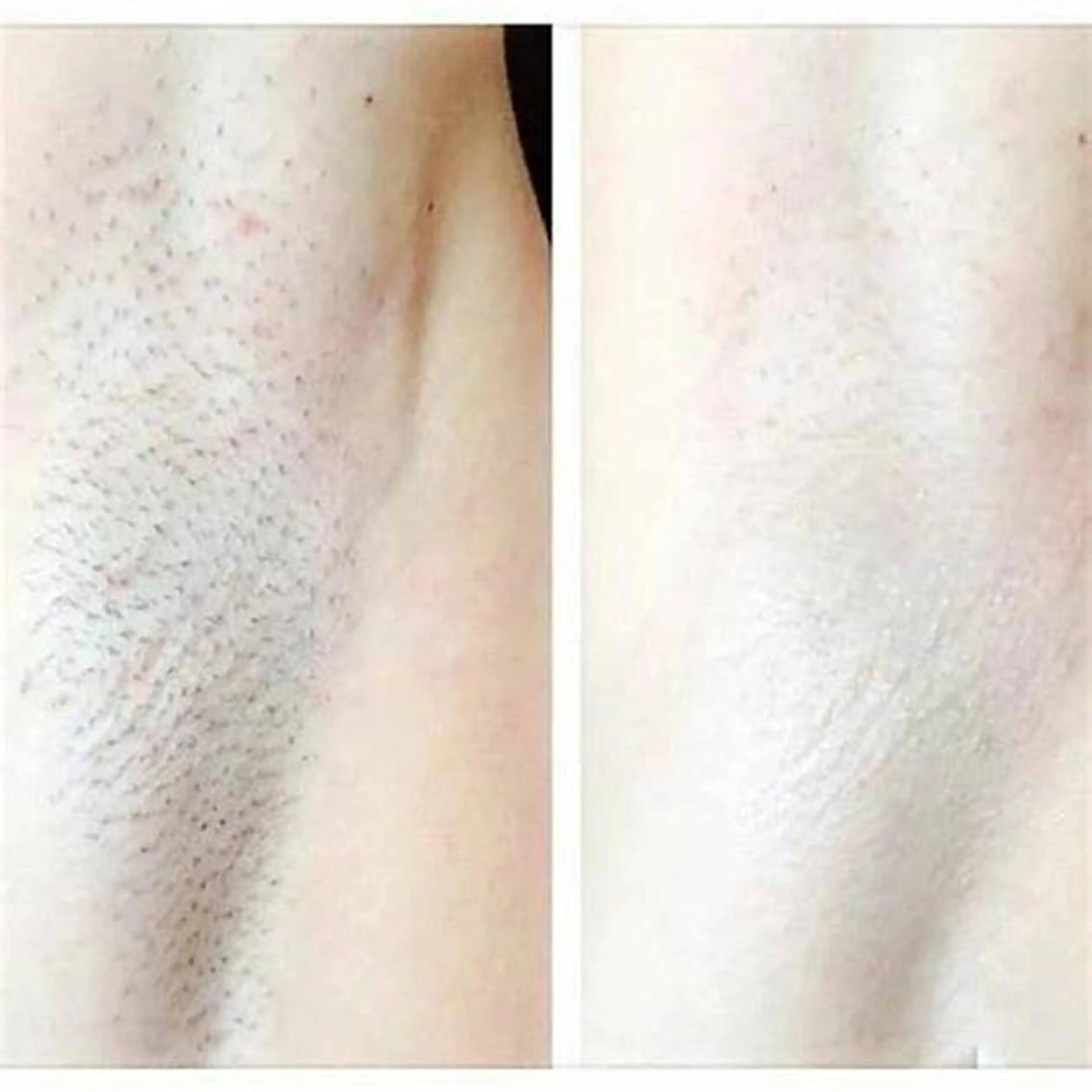 【最新脱毛Man＆Lady👸🏻🤵‍♂️】ワキ脱毛　自己処理卒業の第一歩に✨数分で完了✨　¥7,700⇒\1,100の写真