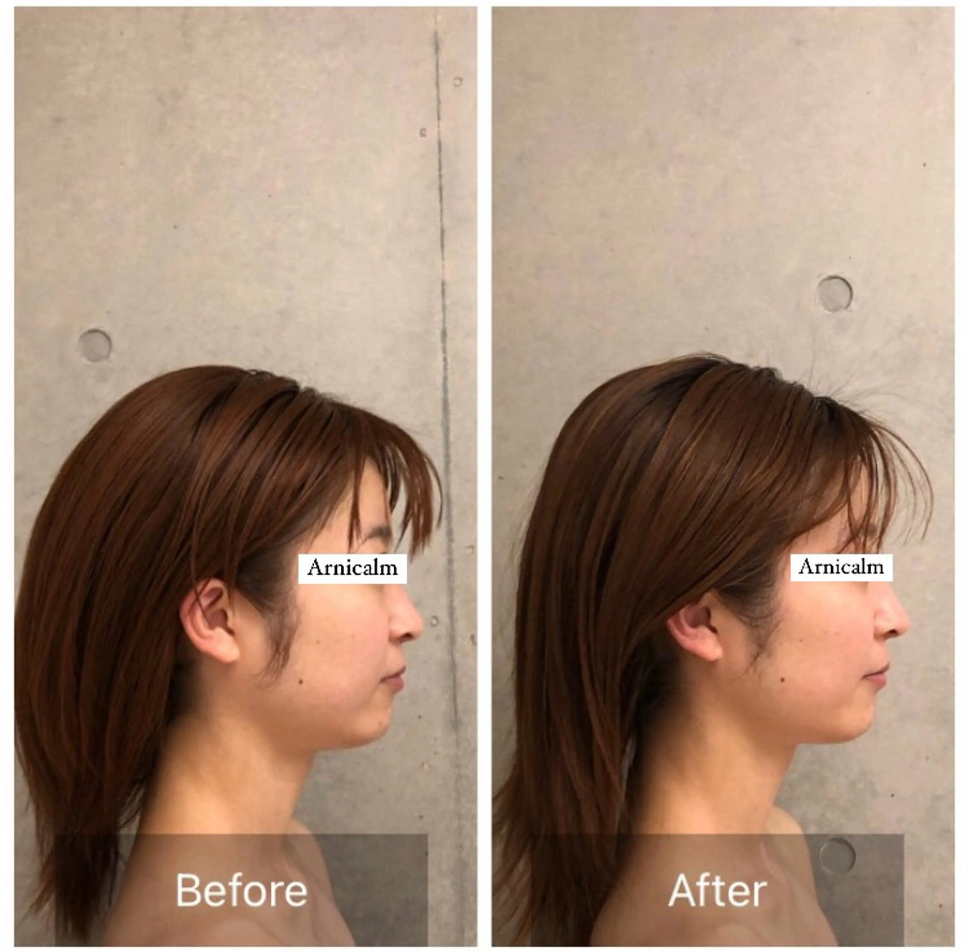 エステ ハーブピーリング 肌再生ピーリング/のエステ・リラクイメージ