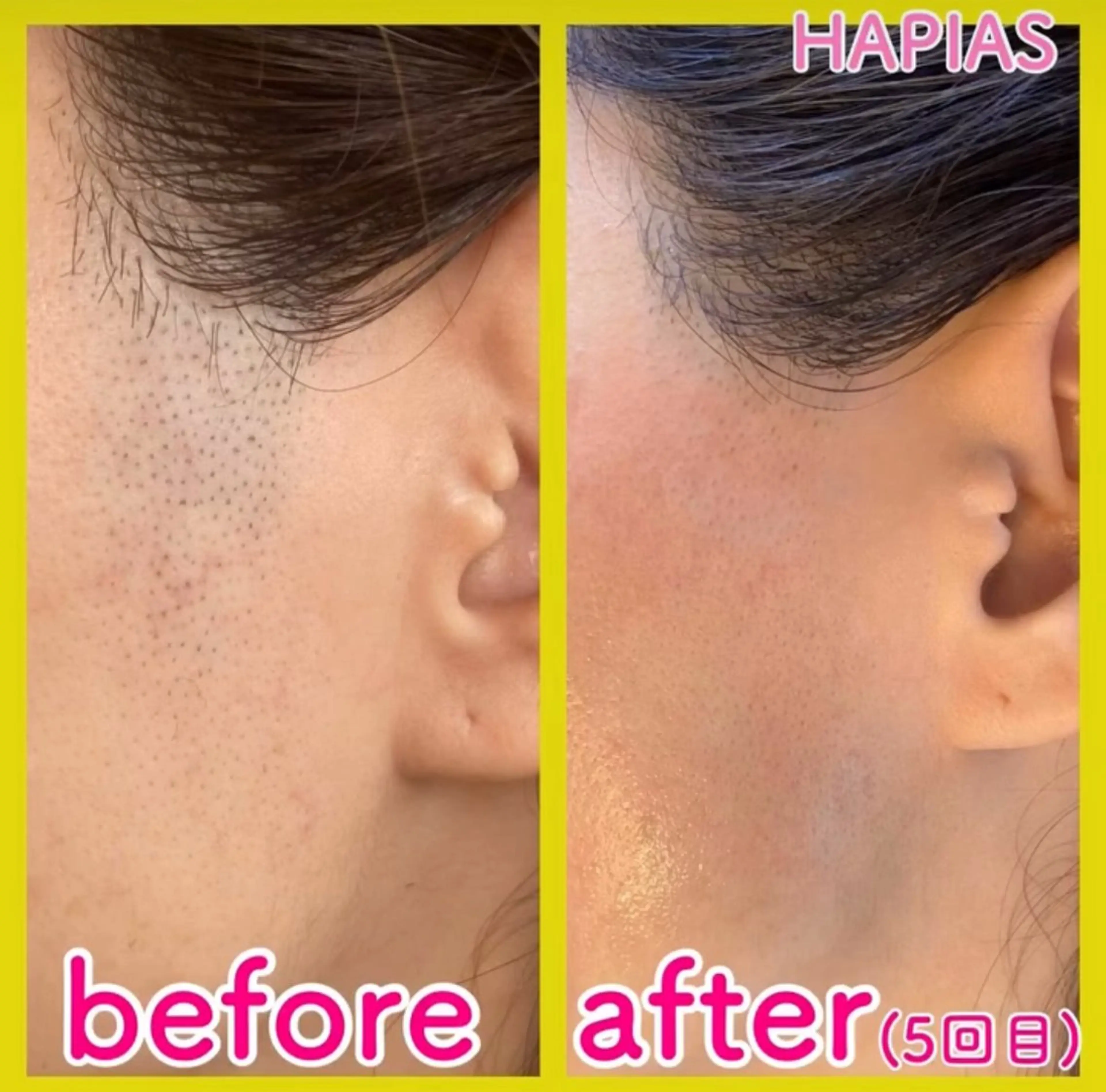 脱毛 staff 山本のエステ・リラクイメージ