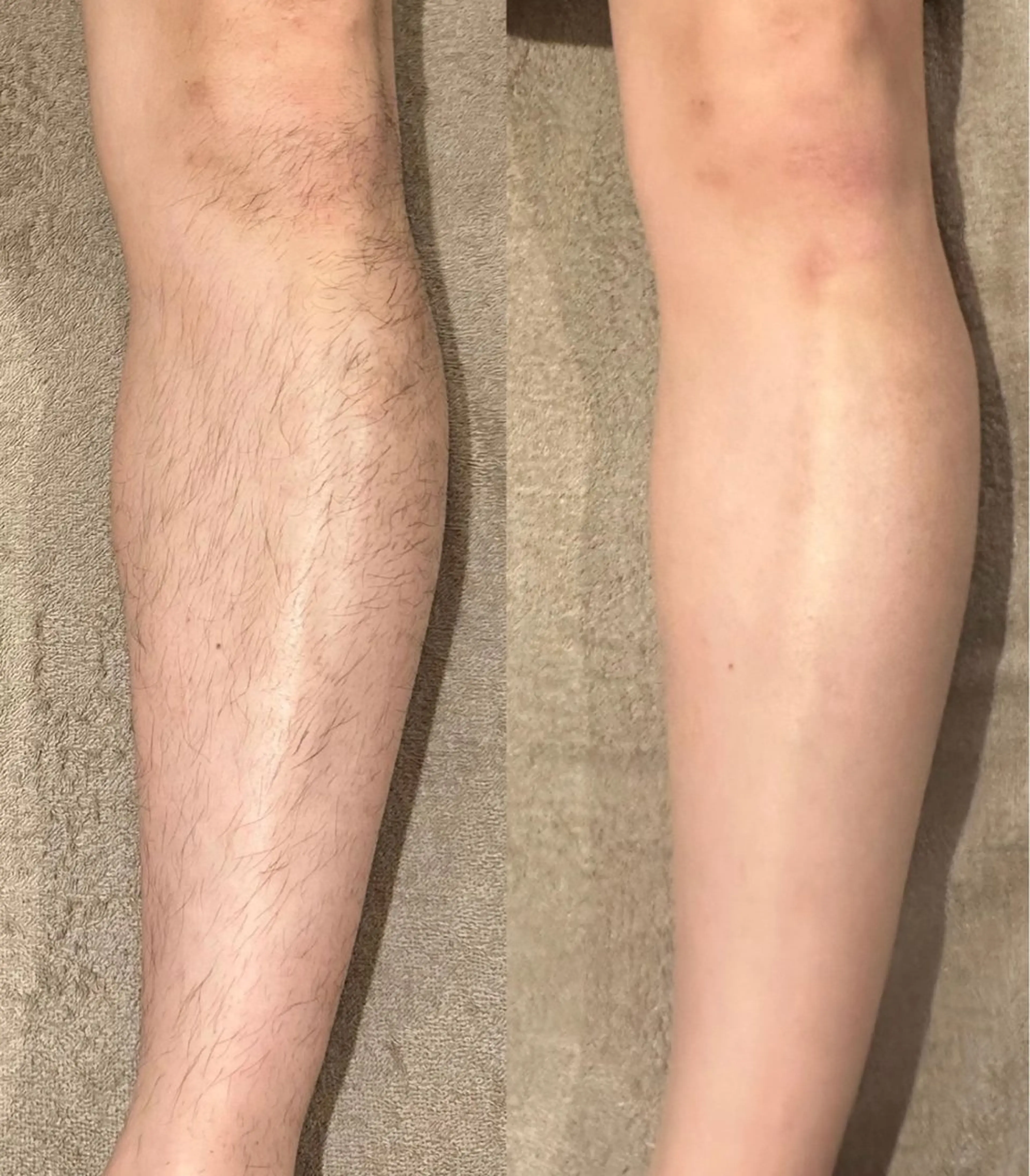 【高校生女子】体育の授業も自信たっぷり🌟ヒザ下脱毛(ヒザ込から足首まで)¥4,400の写真