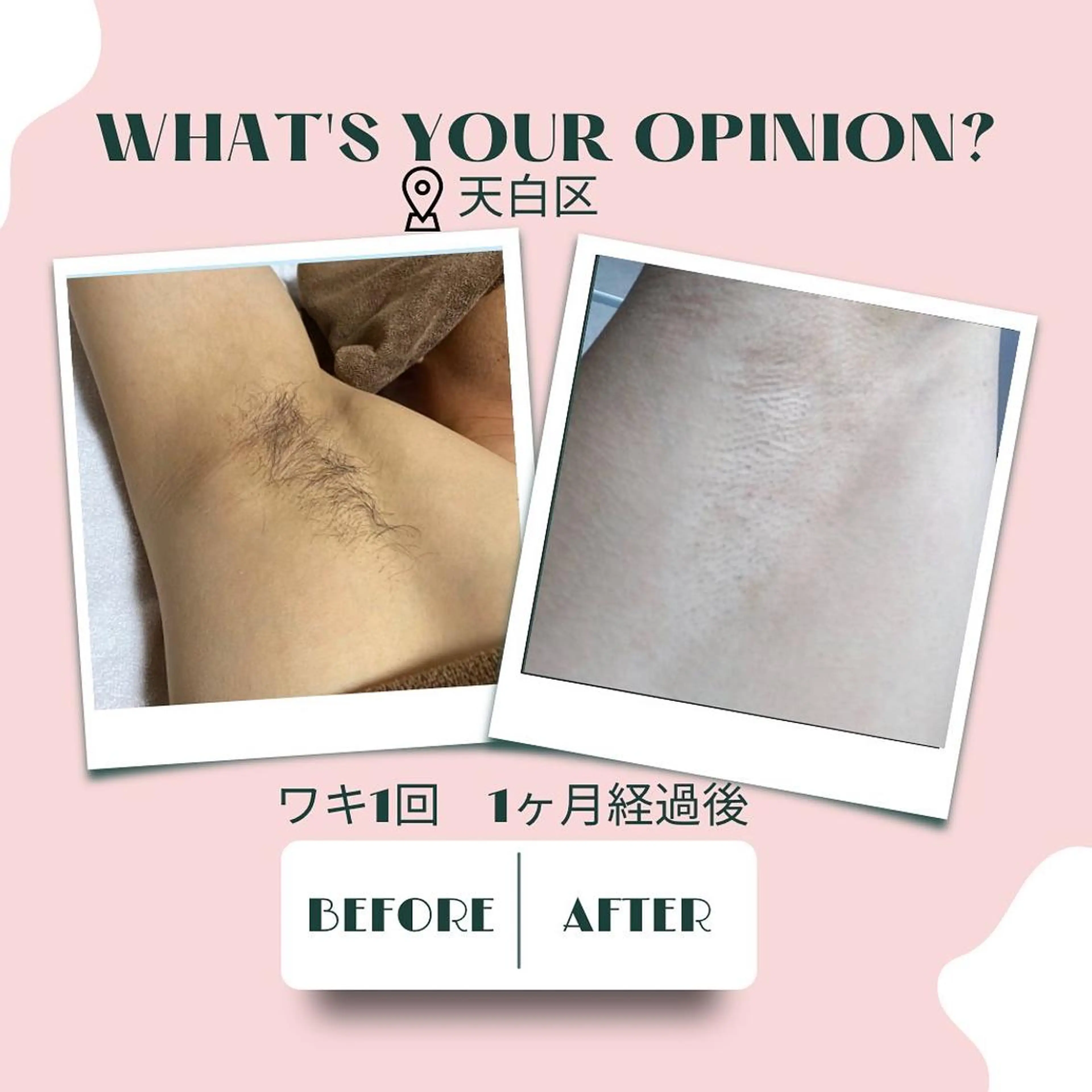 脱毛 🌈松 本🌈のエステ・リラクイメージ