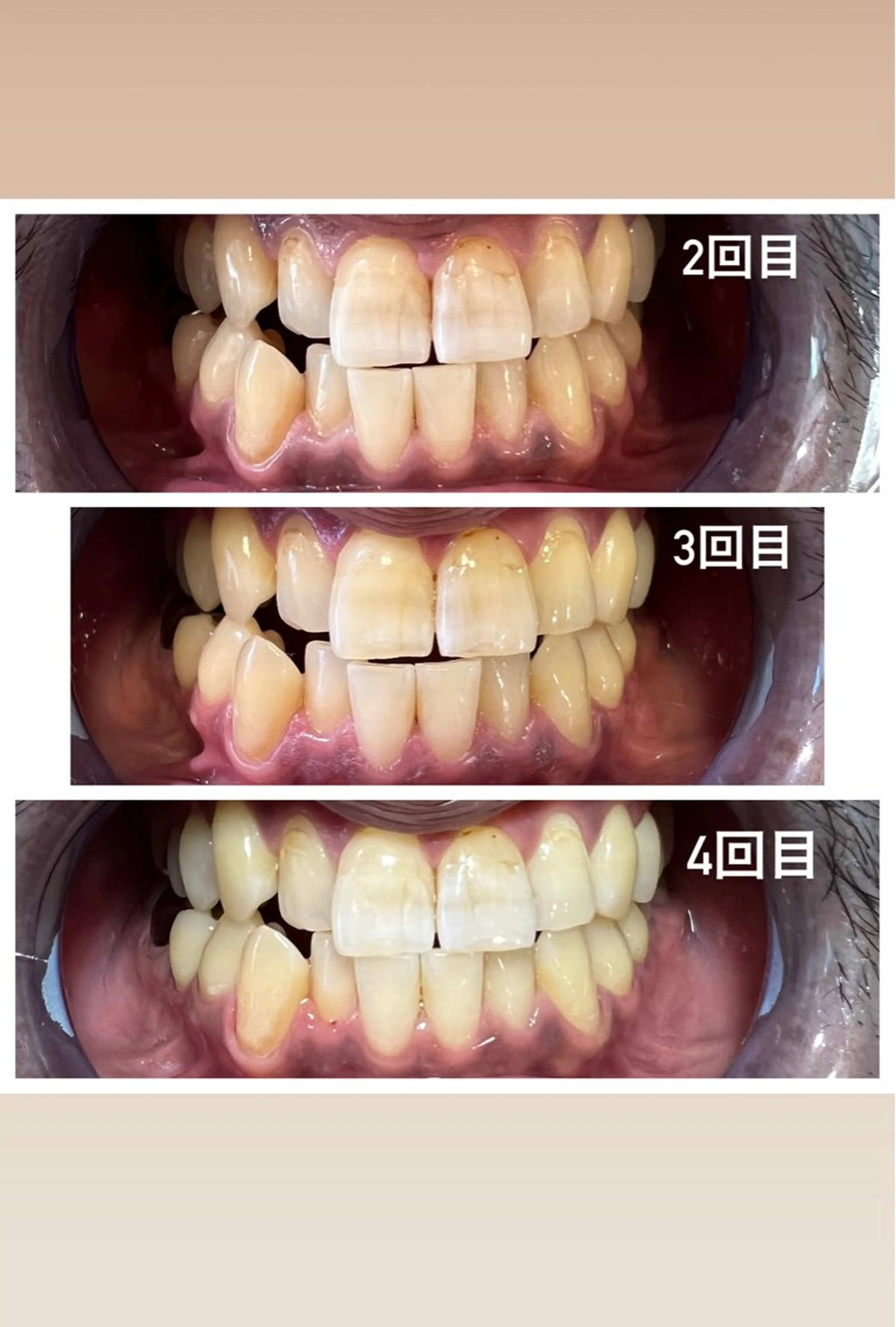 セルフホワイトニング Shineeのエステ・リラクイメージ