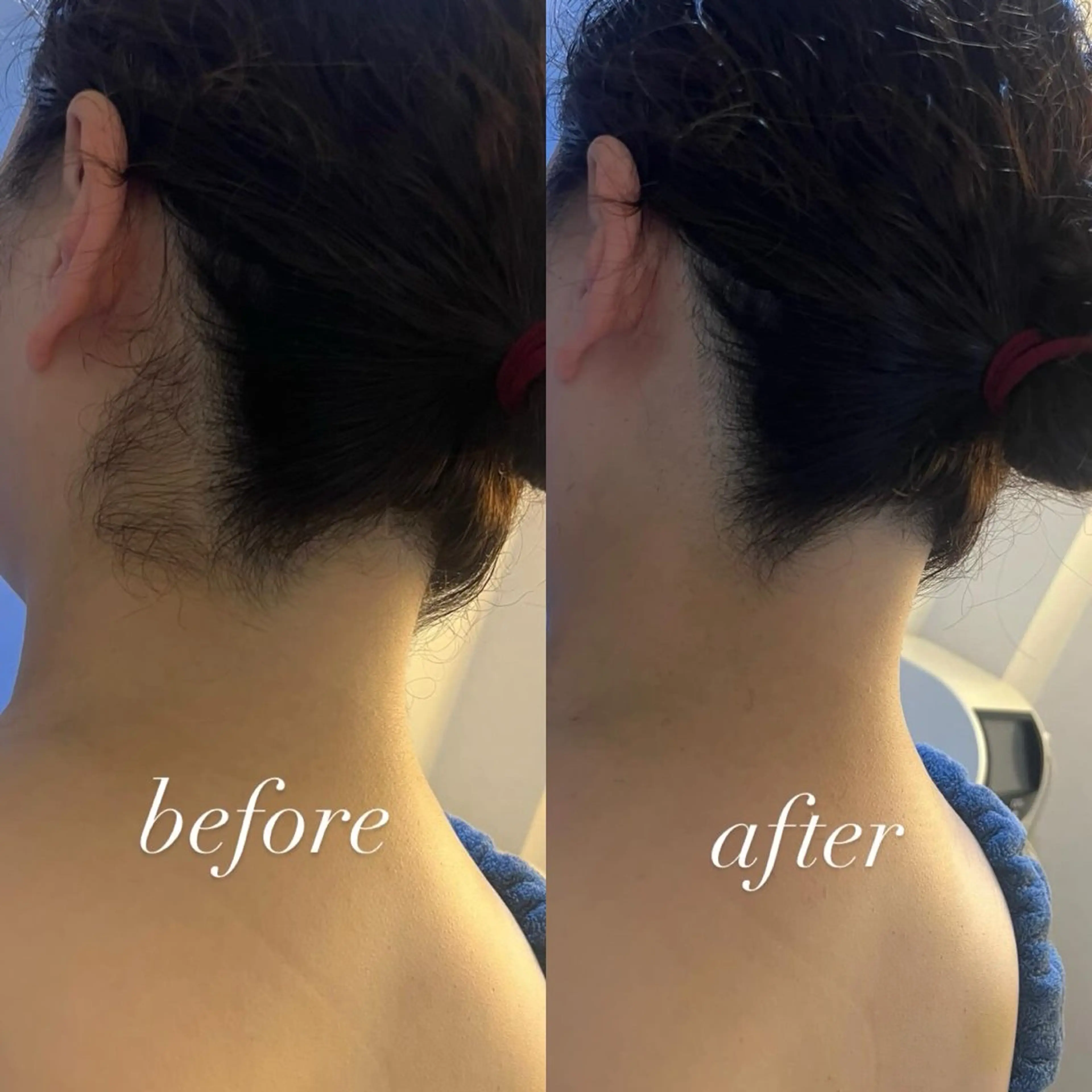 うなじ脱毛/美肌脱毛 LABELのエステ・リラクイメージ