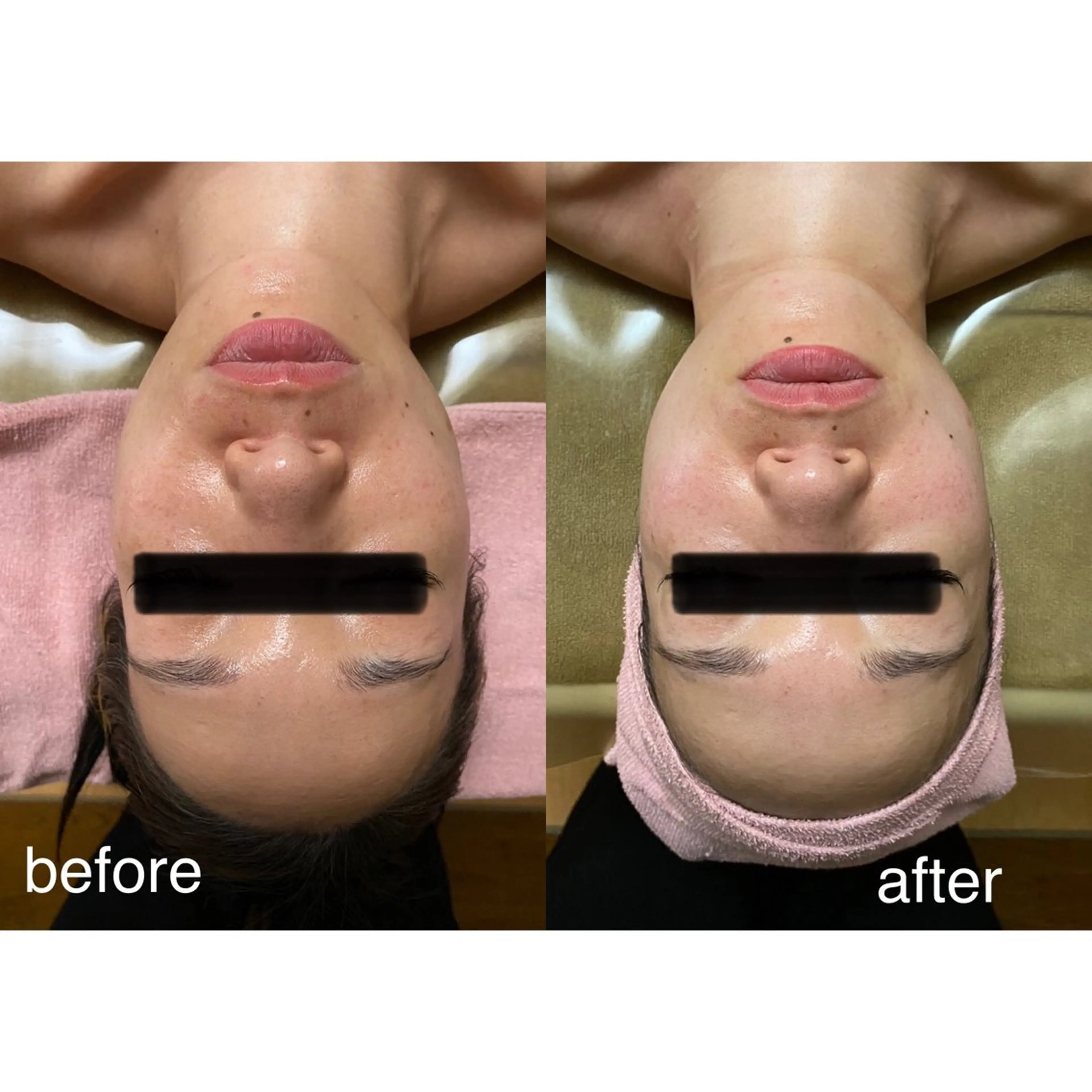 《会員様限定》3D筋膜ストレッチ小顔術の写真