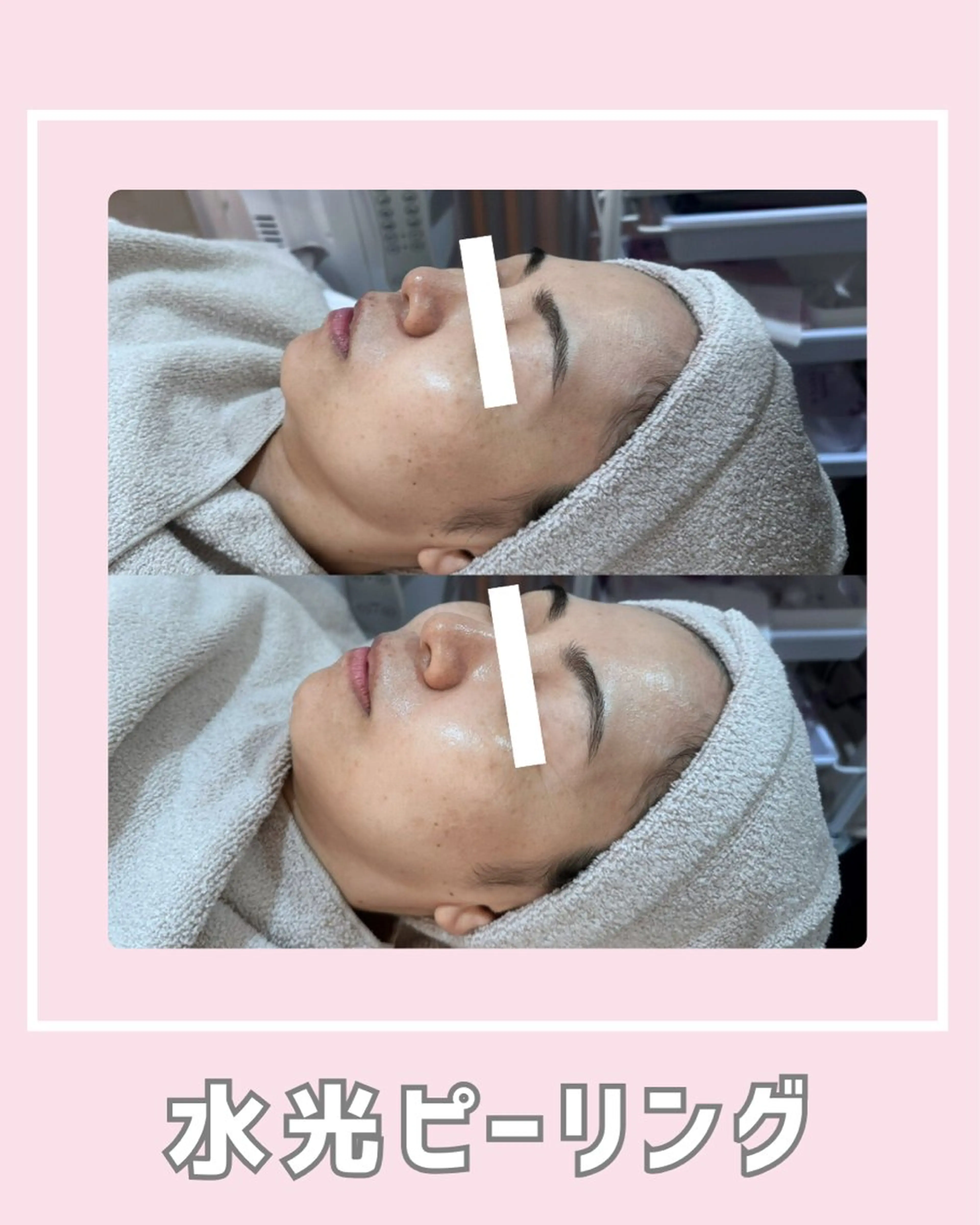 エステ |ピーリング・毛穴| soina神楽坂のエステ・リラクイメージ