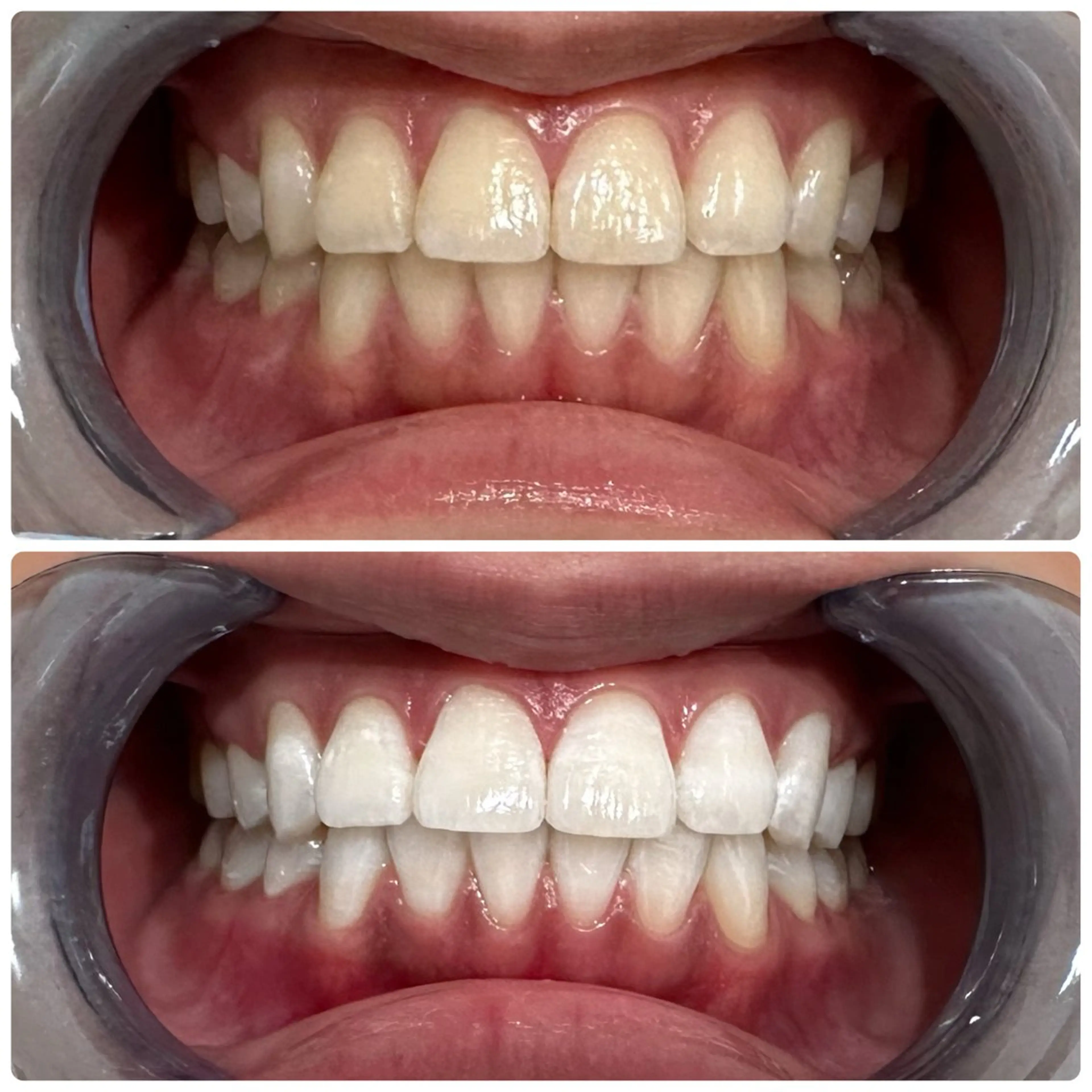 【遠方の方向け】★セルフホワイトニング都度メニュー★￥11000→￥8800の写真